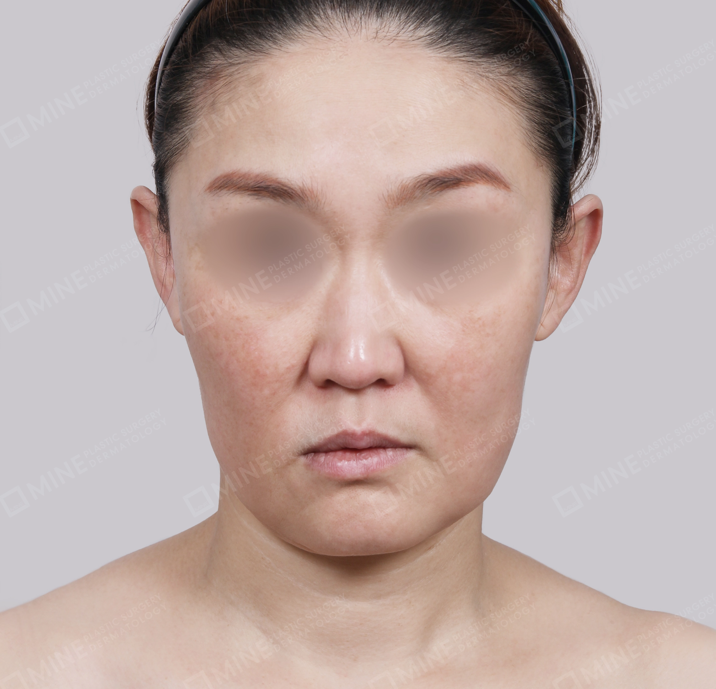 Căng da toàn mặt-Mặt trước-Trước