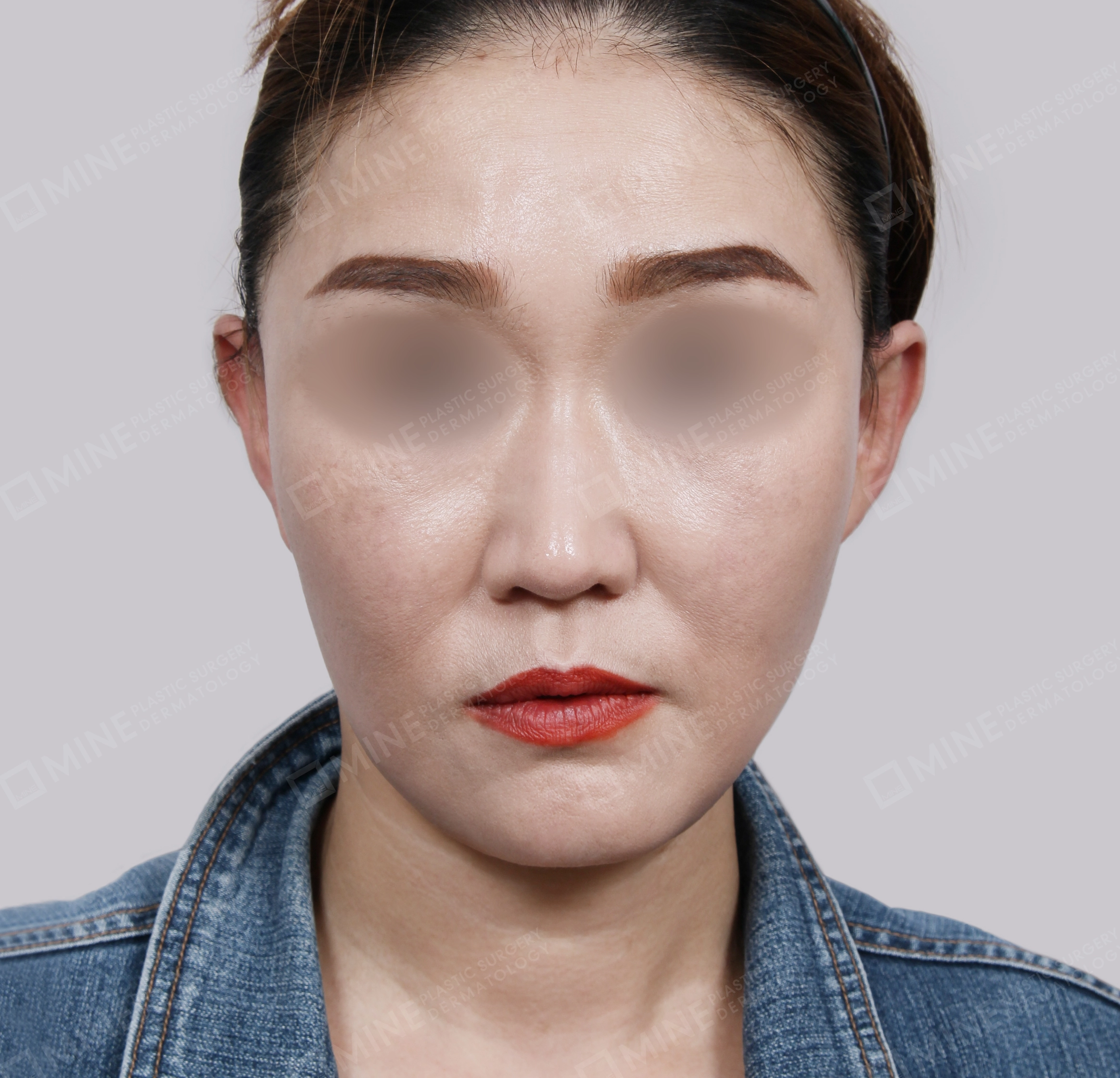 Căng da toàn mặt-Mặt trước-Sau