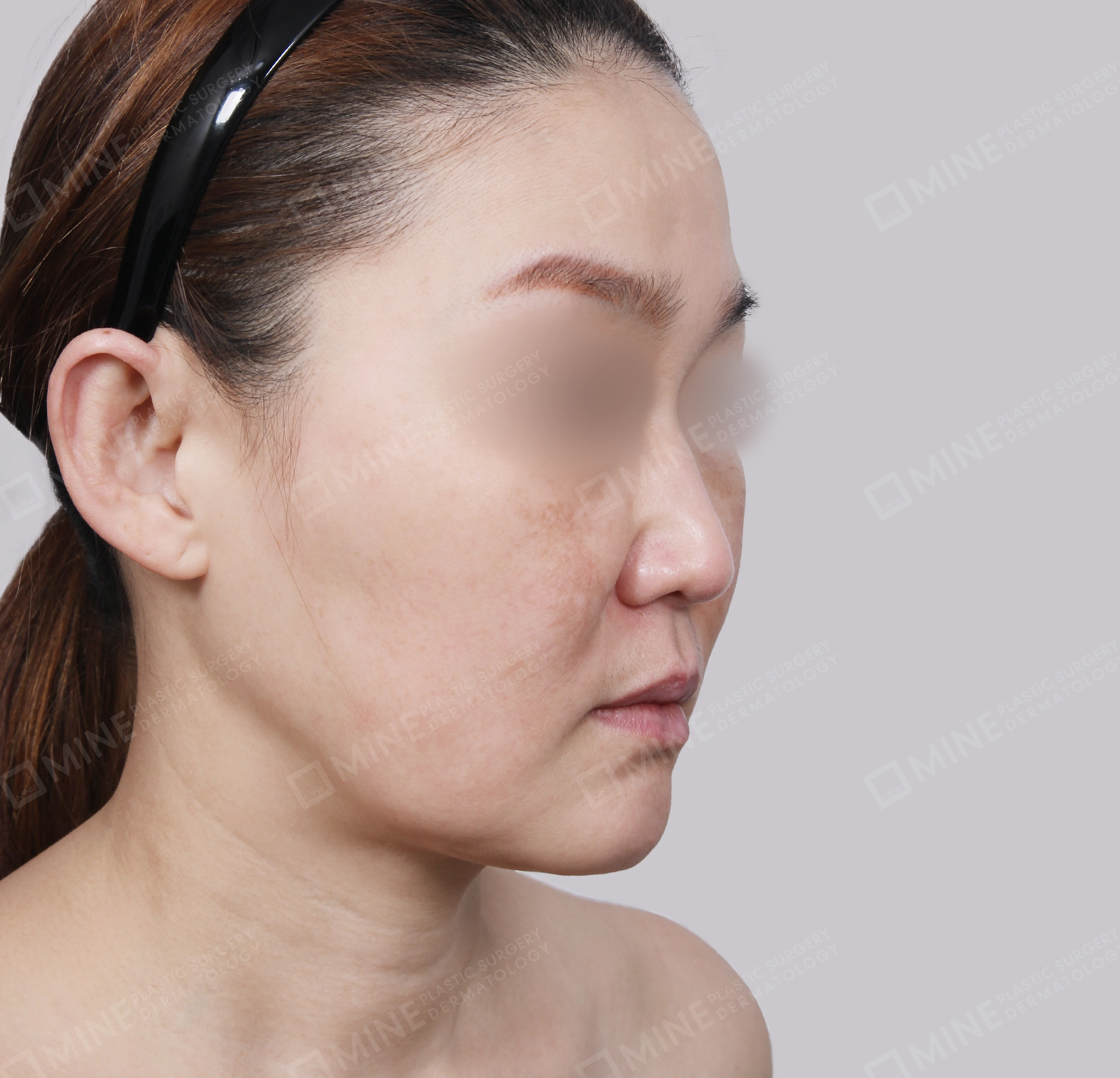 Căng da toàn mặt-45 độ-Trước