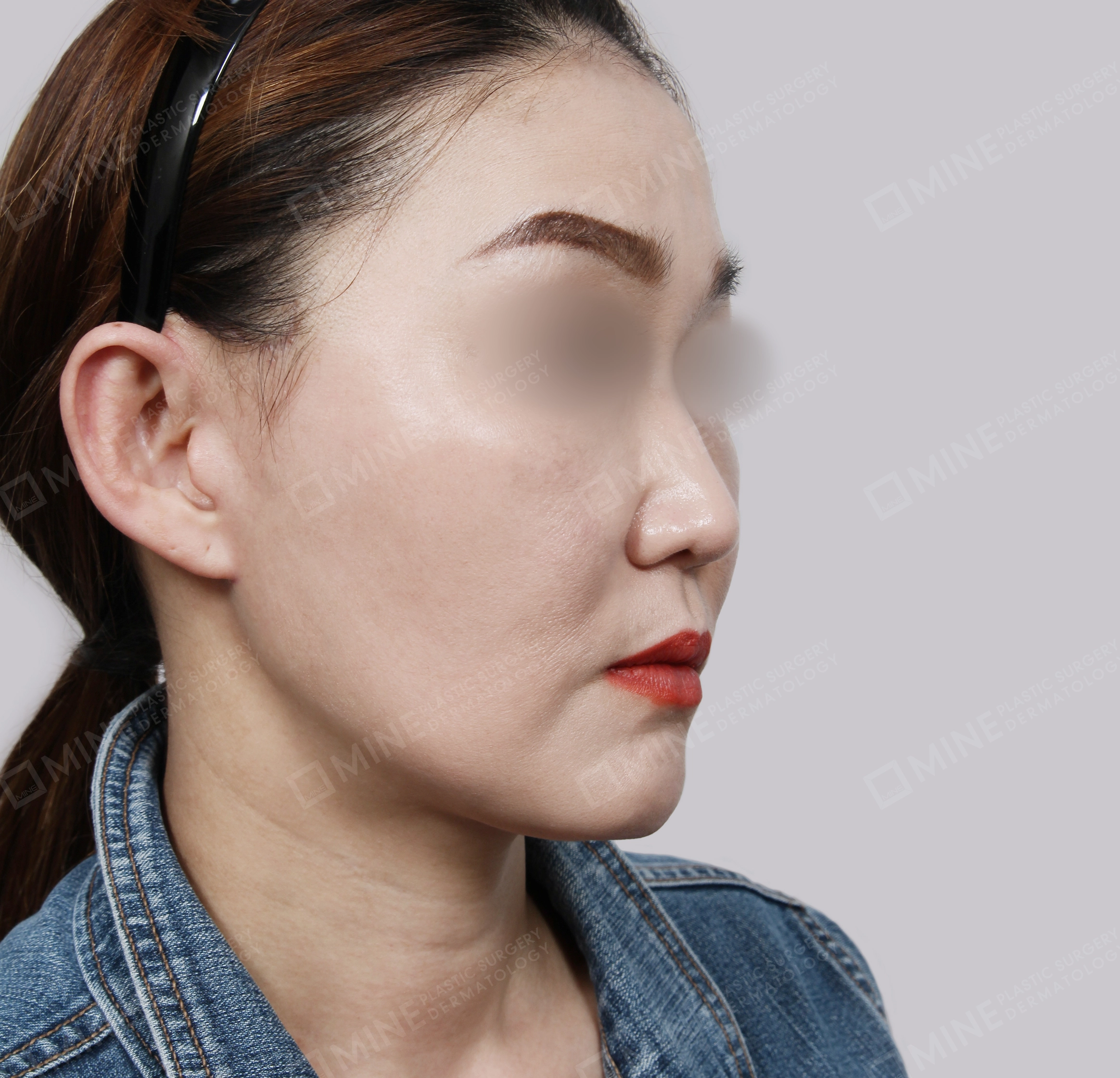 Căng da toàn mặt-45 độ-Sau
