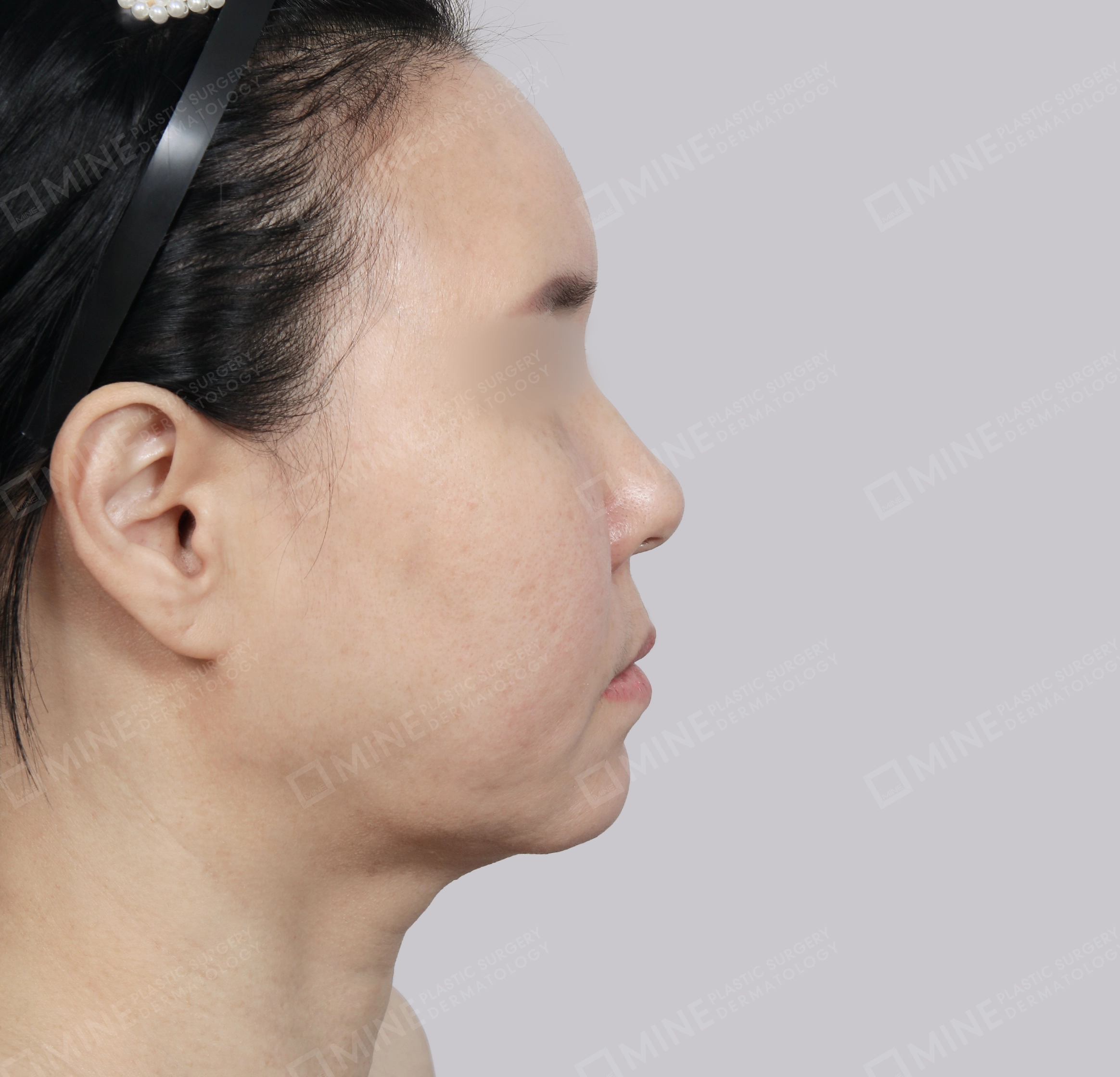 Căng da toàn mặt-Mặt bên-Trước