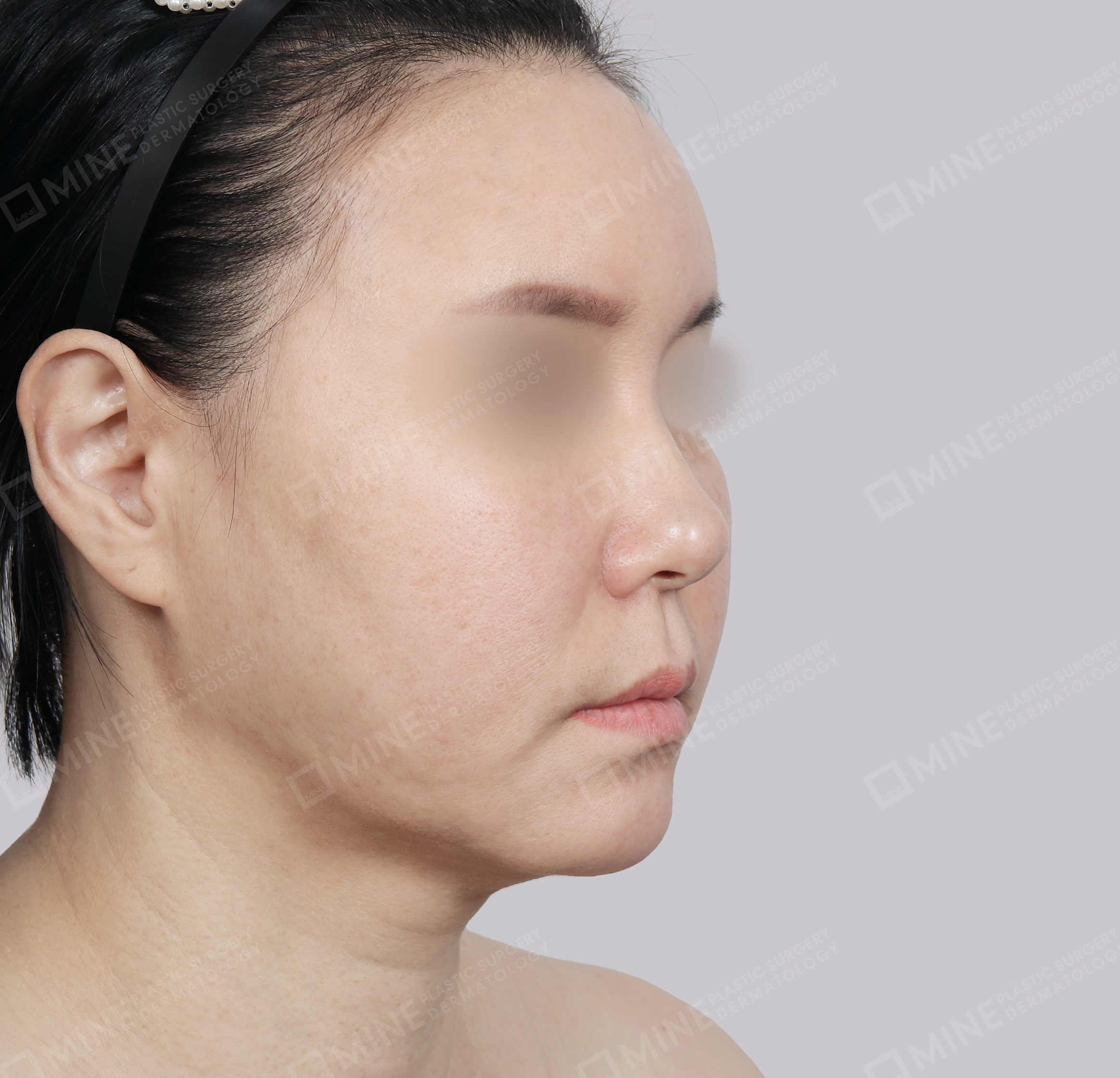 Căng da toàn mặt-45 độ-Trước
