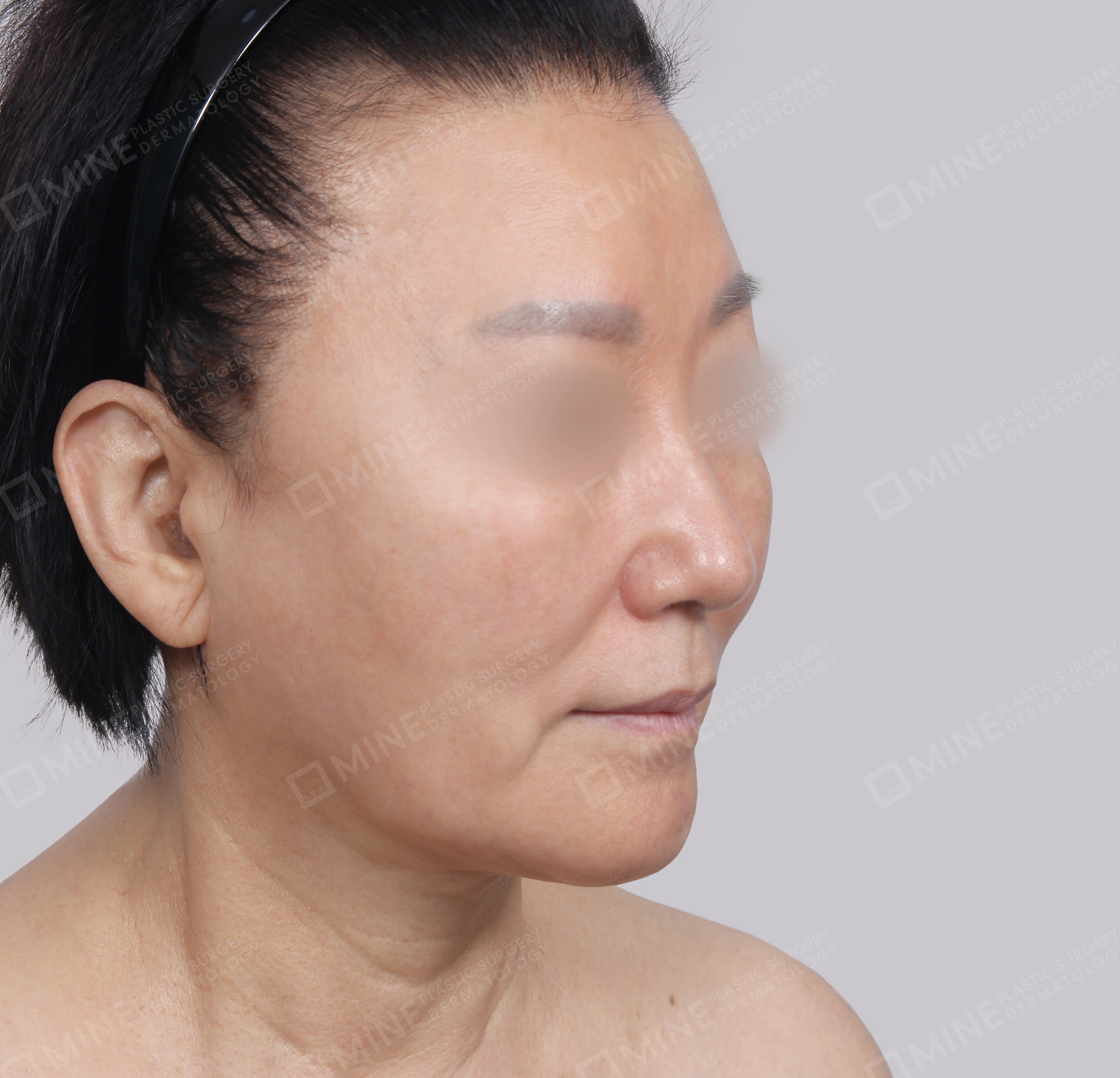 Căng da toàn mặt-45 độ-Trước