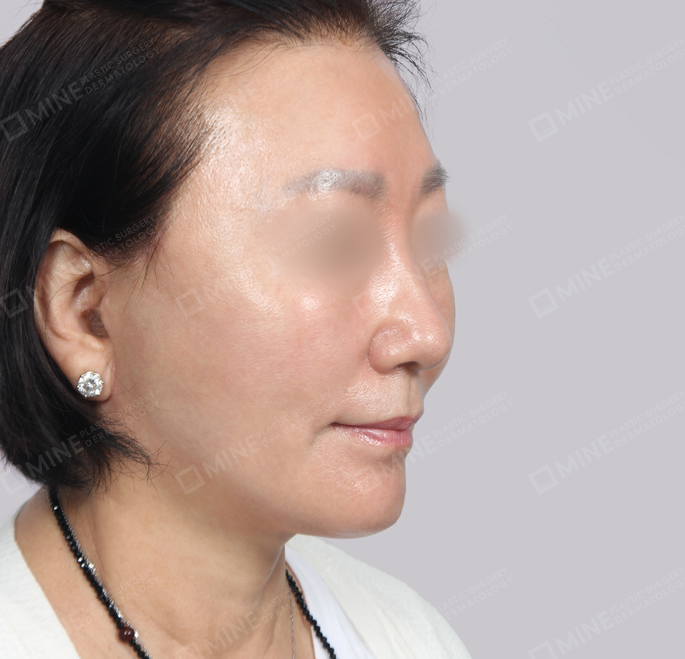 Căng da toàn mặt-45 độ-Sau