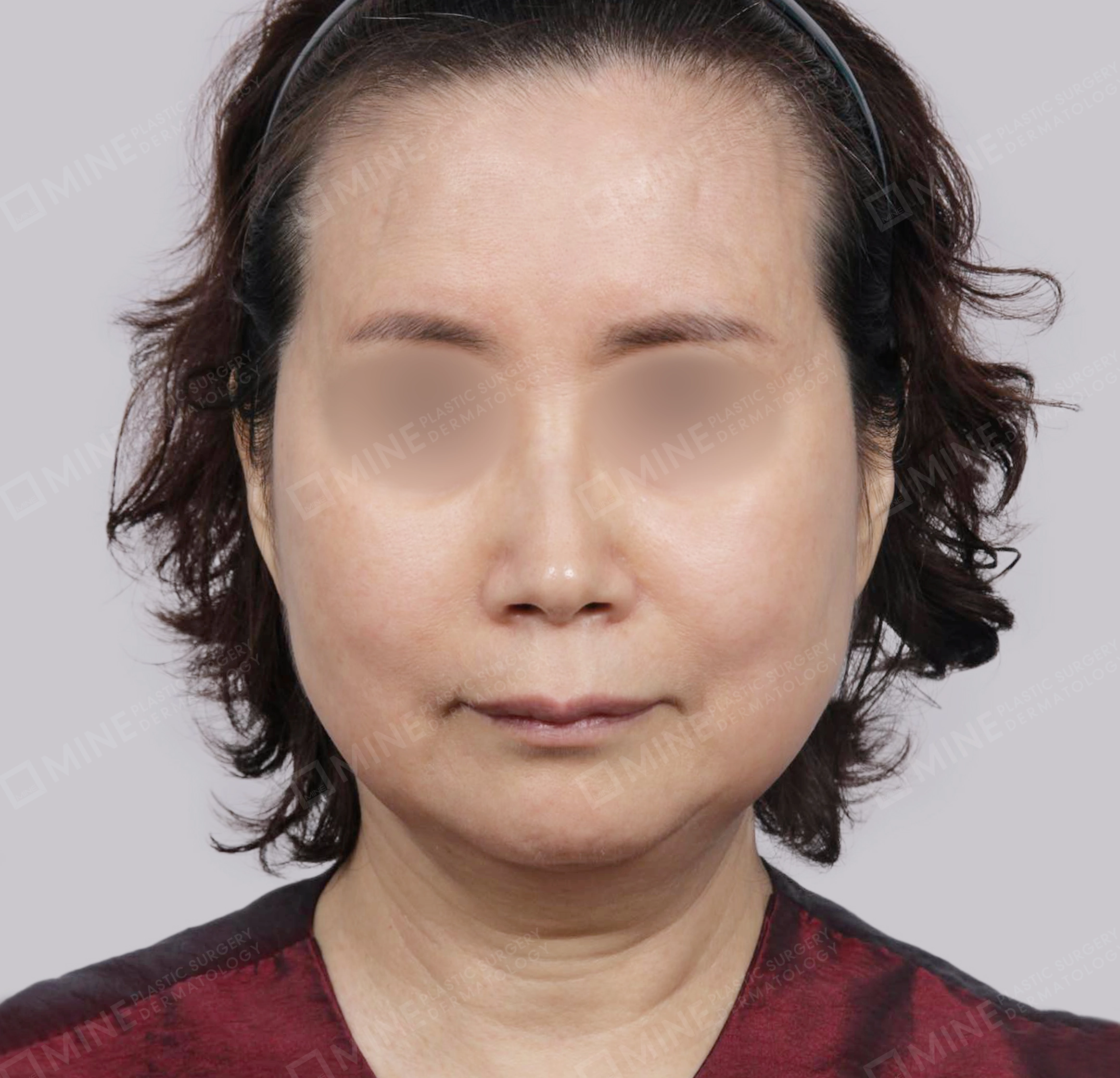 Căng da toàn mặt-Mặt trước-Trước