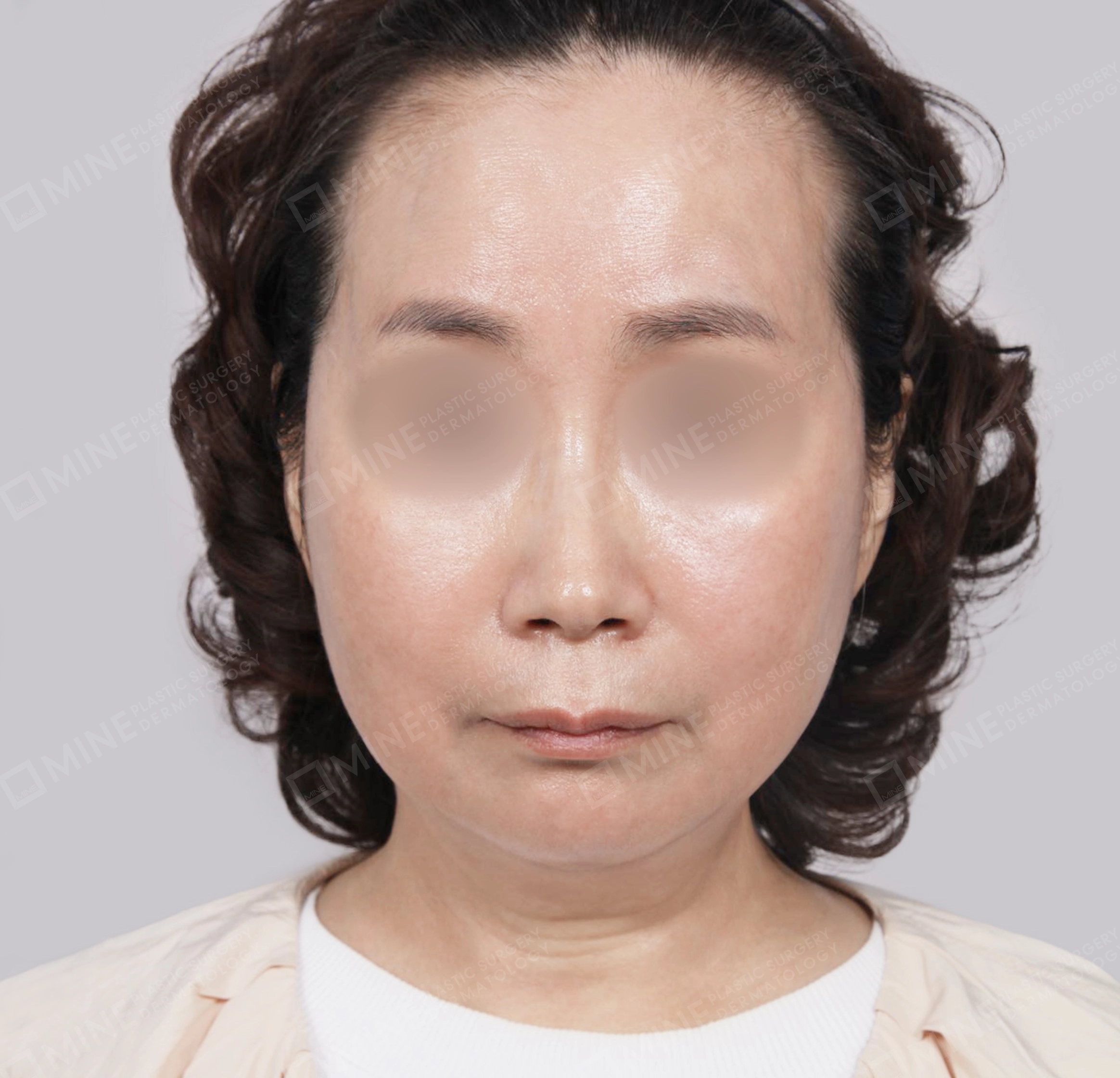 Căng da toàn mặt-Mặt trước-Sau