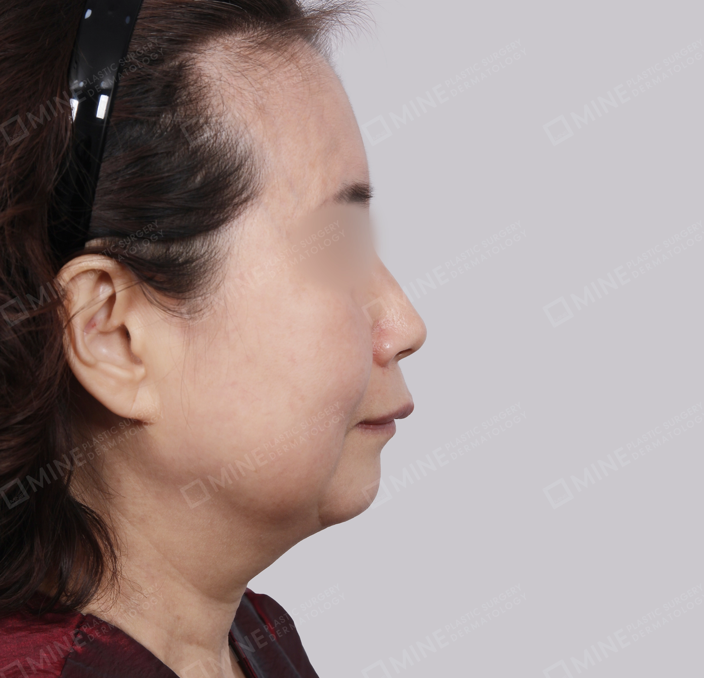 Căng da toàn mặt-Mặt bên-Trước
