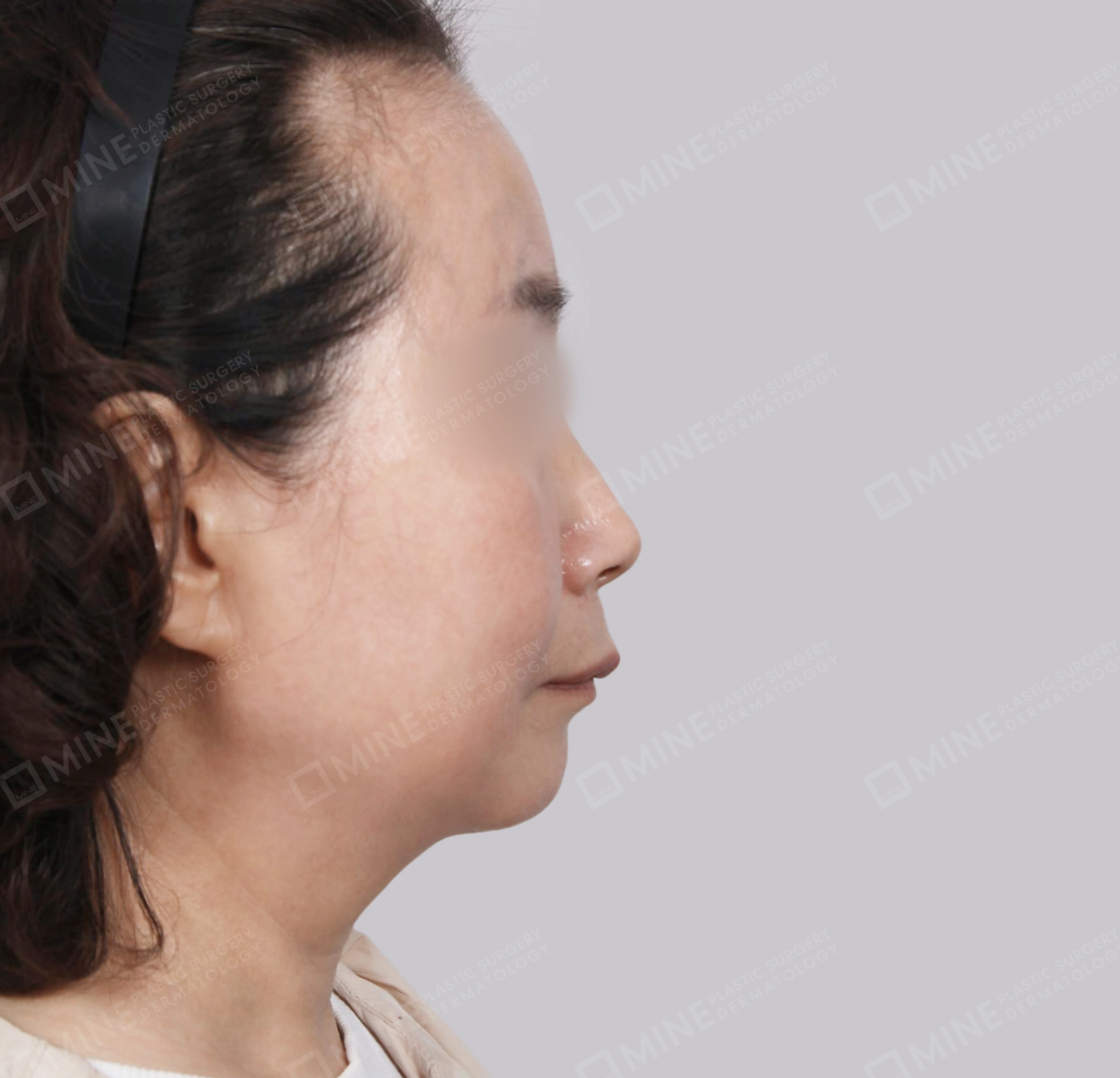 Căng da toàn mặt-Mặt bên-Sau