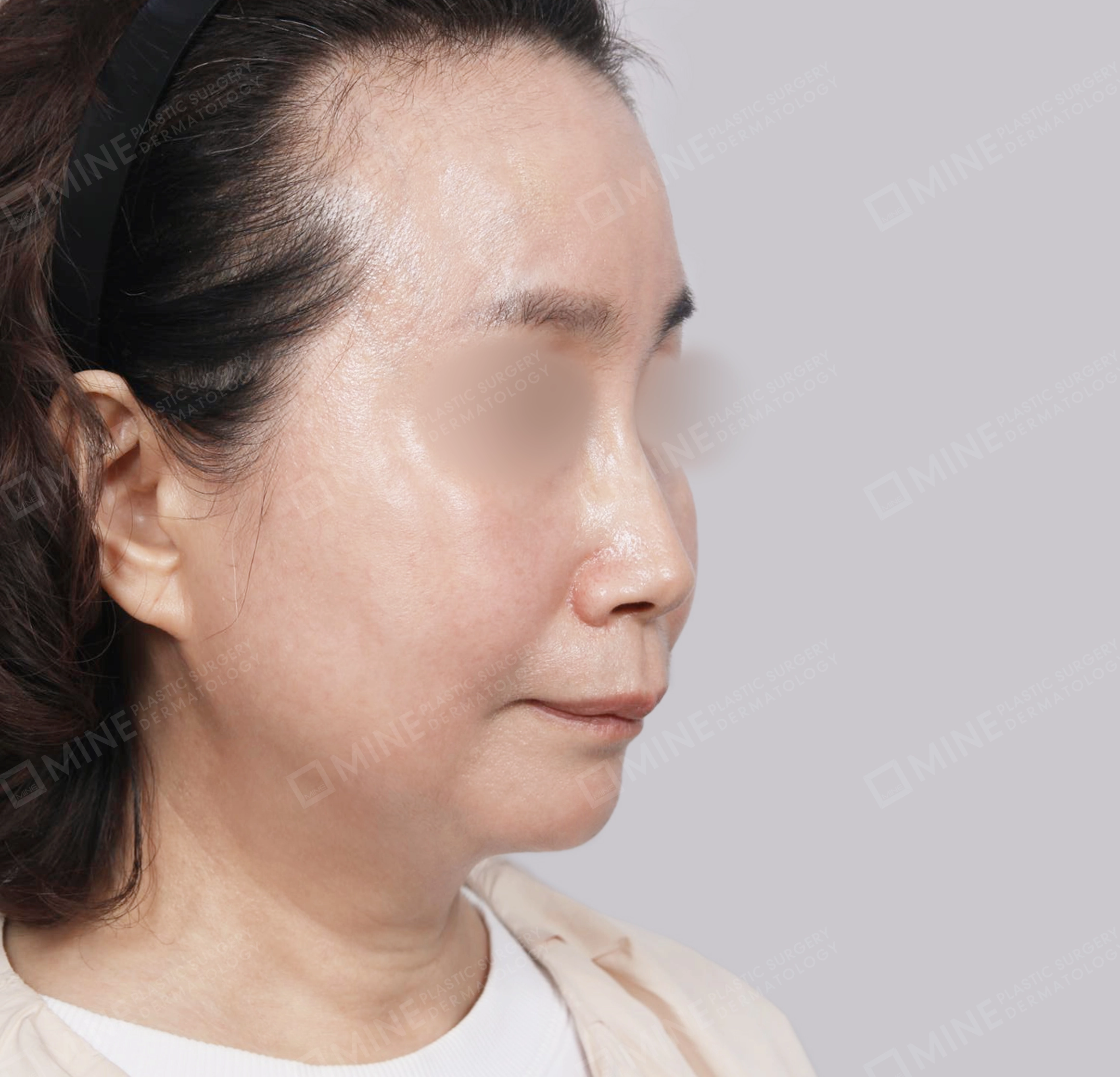 Căng da toàn mặt-45 độ-Sau