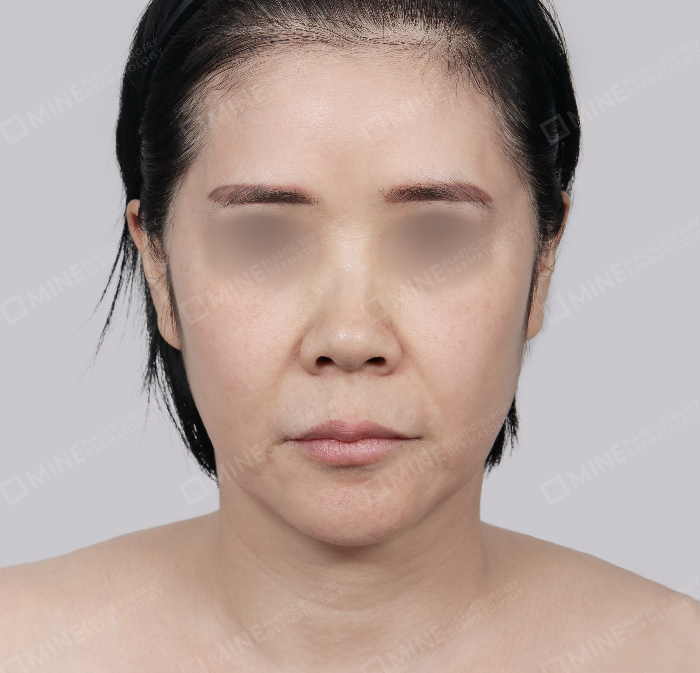Căng da toàn mặt-Mặt trước-Trước