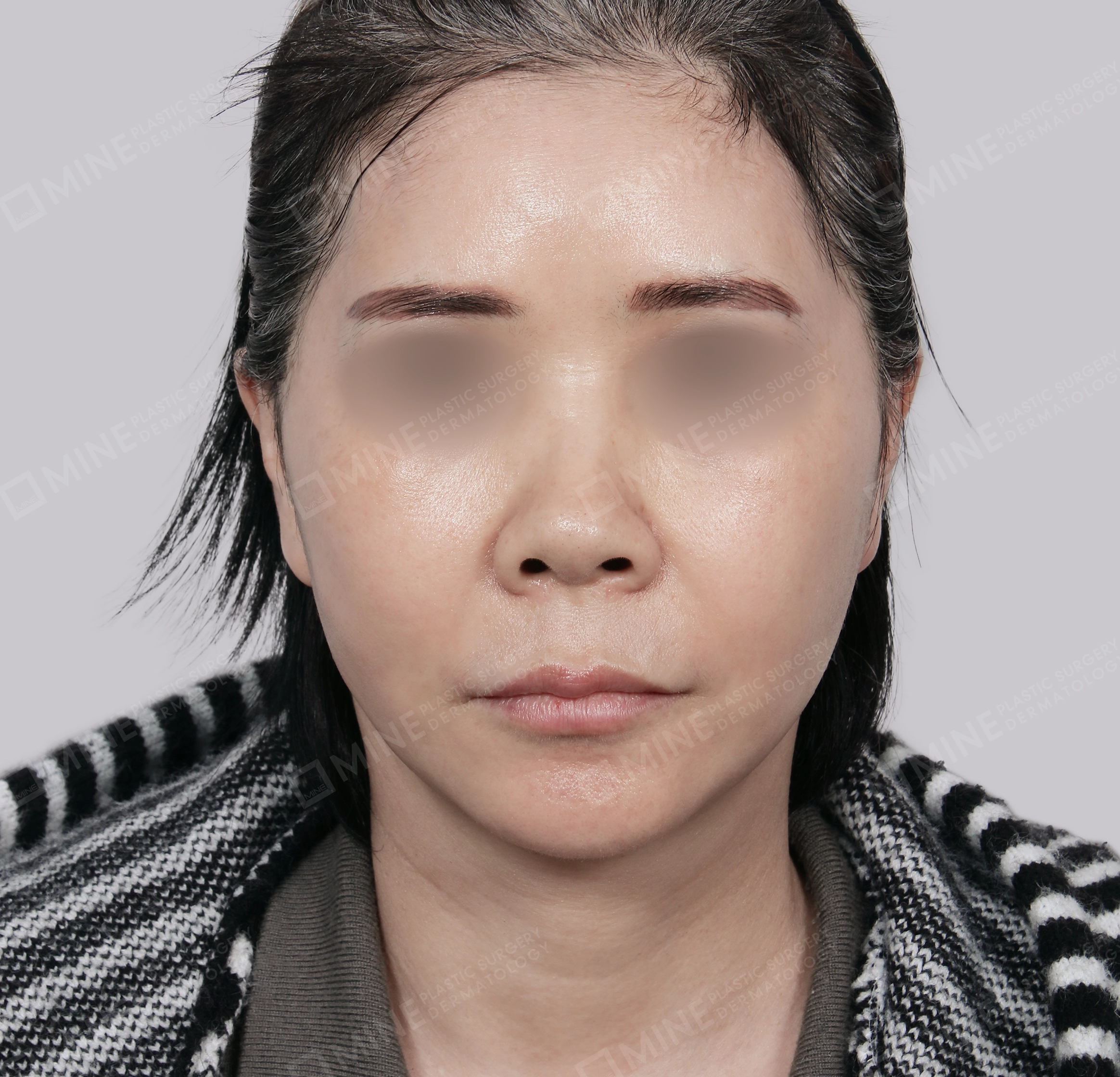 Căng da toàn mặt-Mặt trước-Sau
