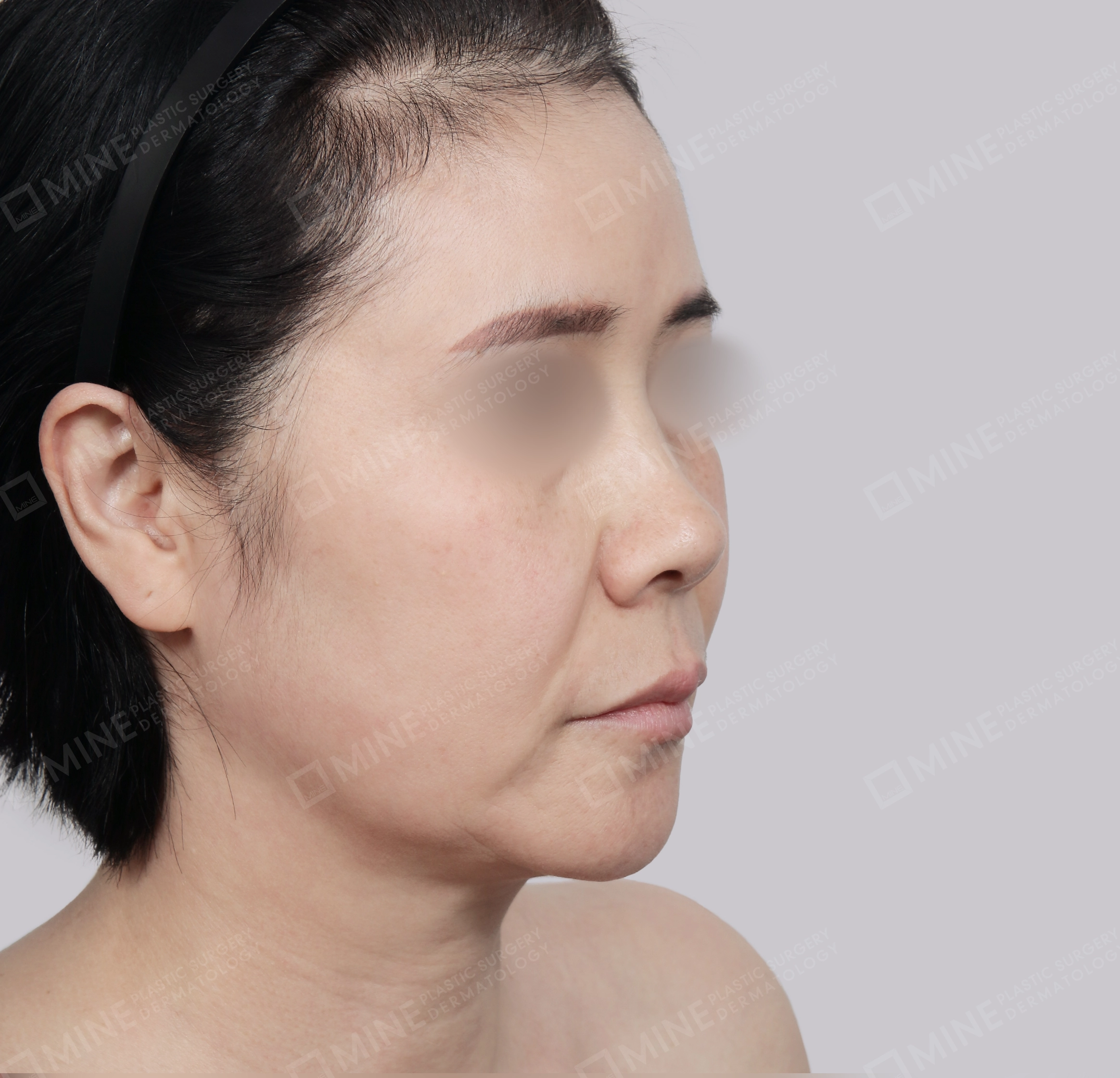 Căng da toàn mặt-45 độ-Trước