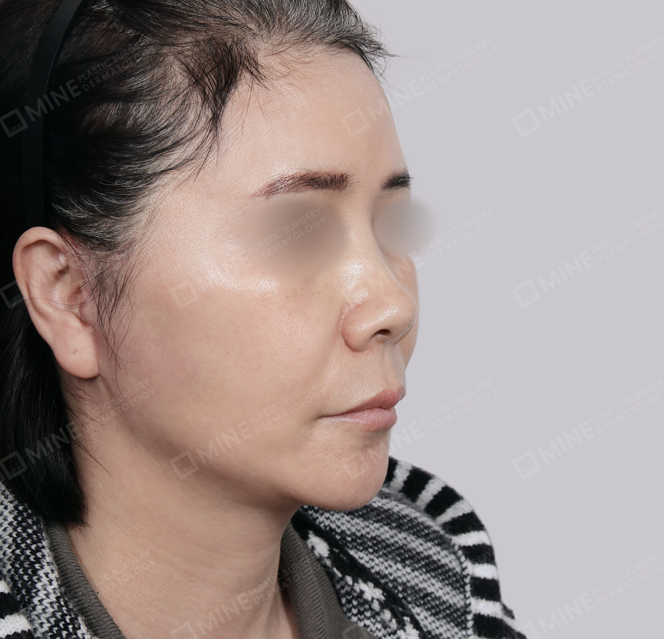 Căng da toàn mặt-45 độ-Sau