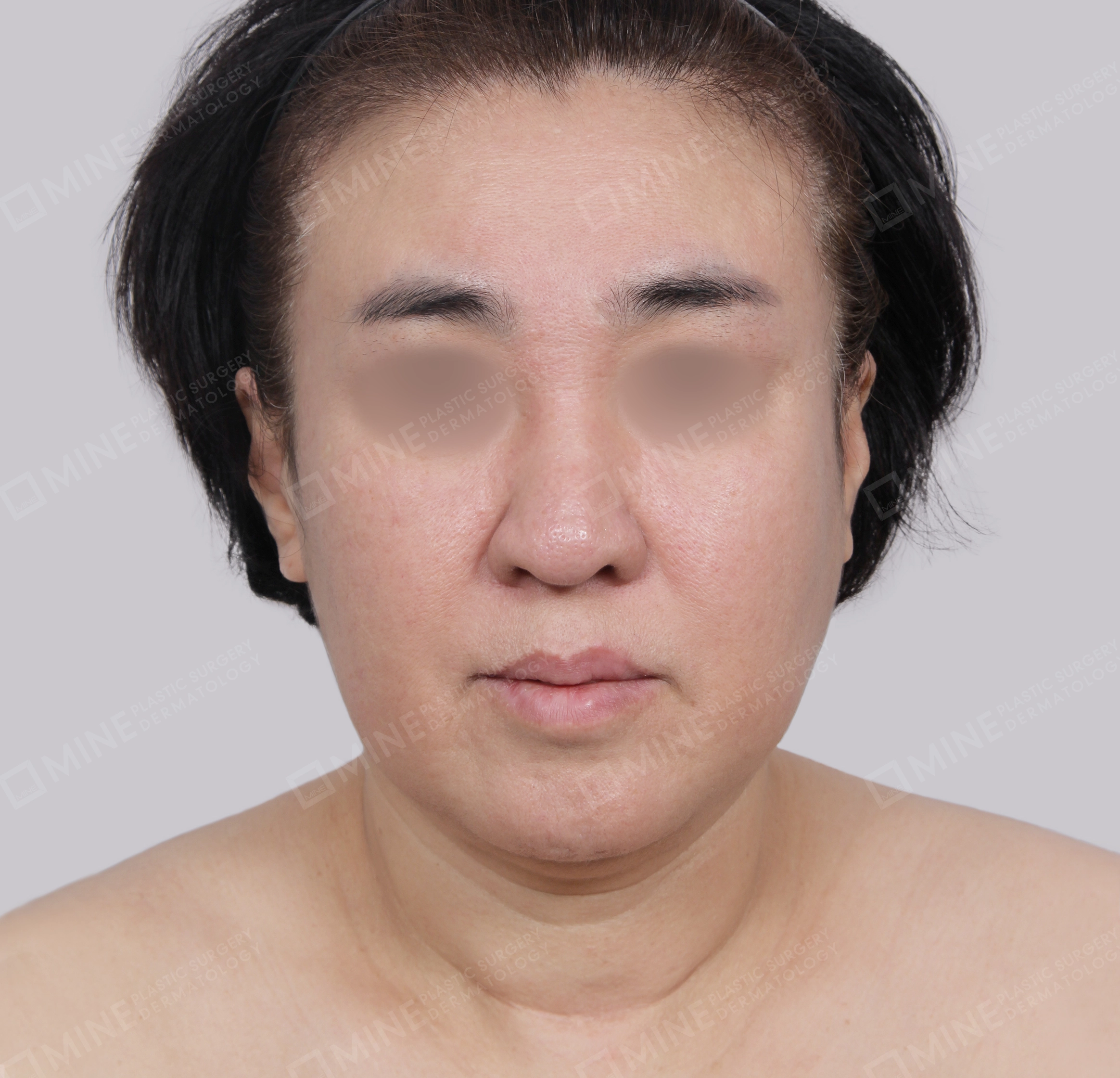 Căng da toàn mặt-Mặt trước-Trước