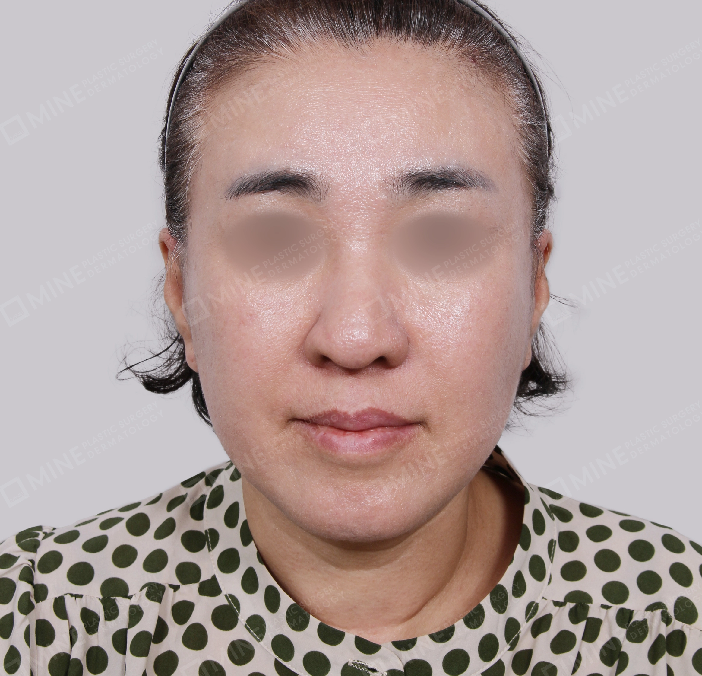 Căng da toàn mặt-Mặt trước-Sau