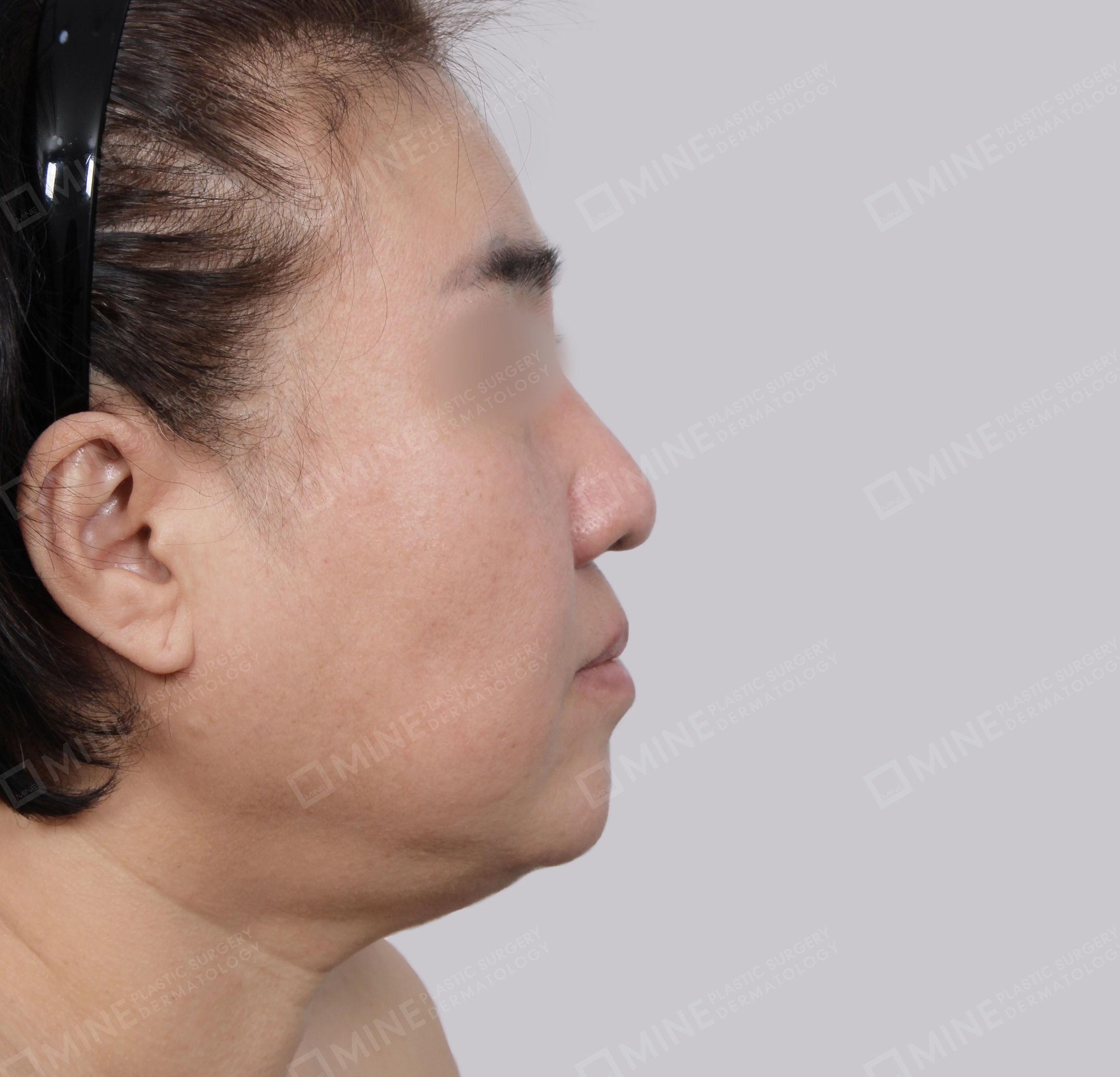 Căng da toàn mặt-Mặt bên-Trước