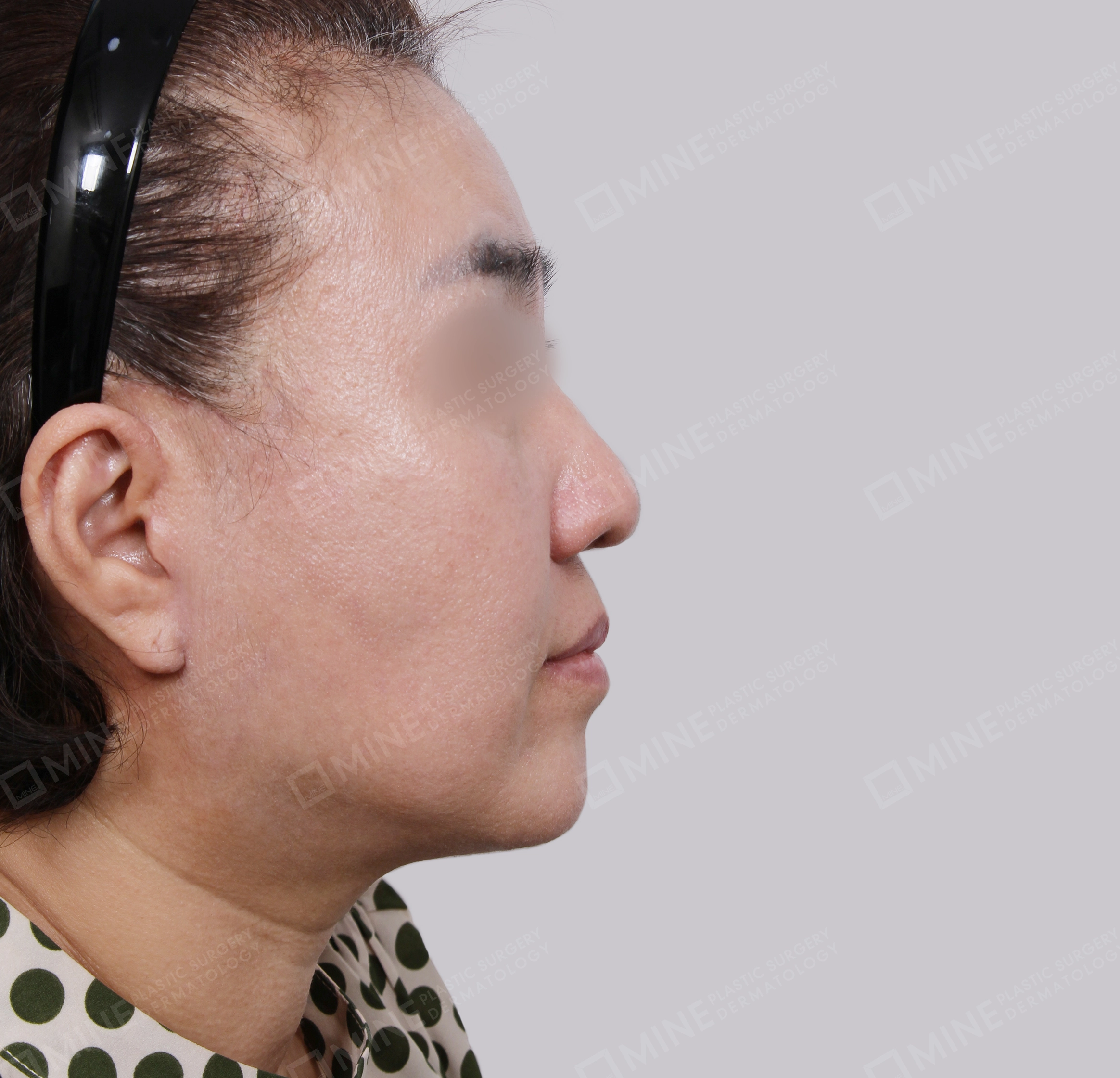 Căng da toàn mặt-Mặt bên-Sau
