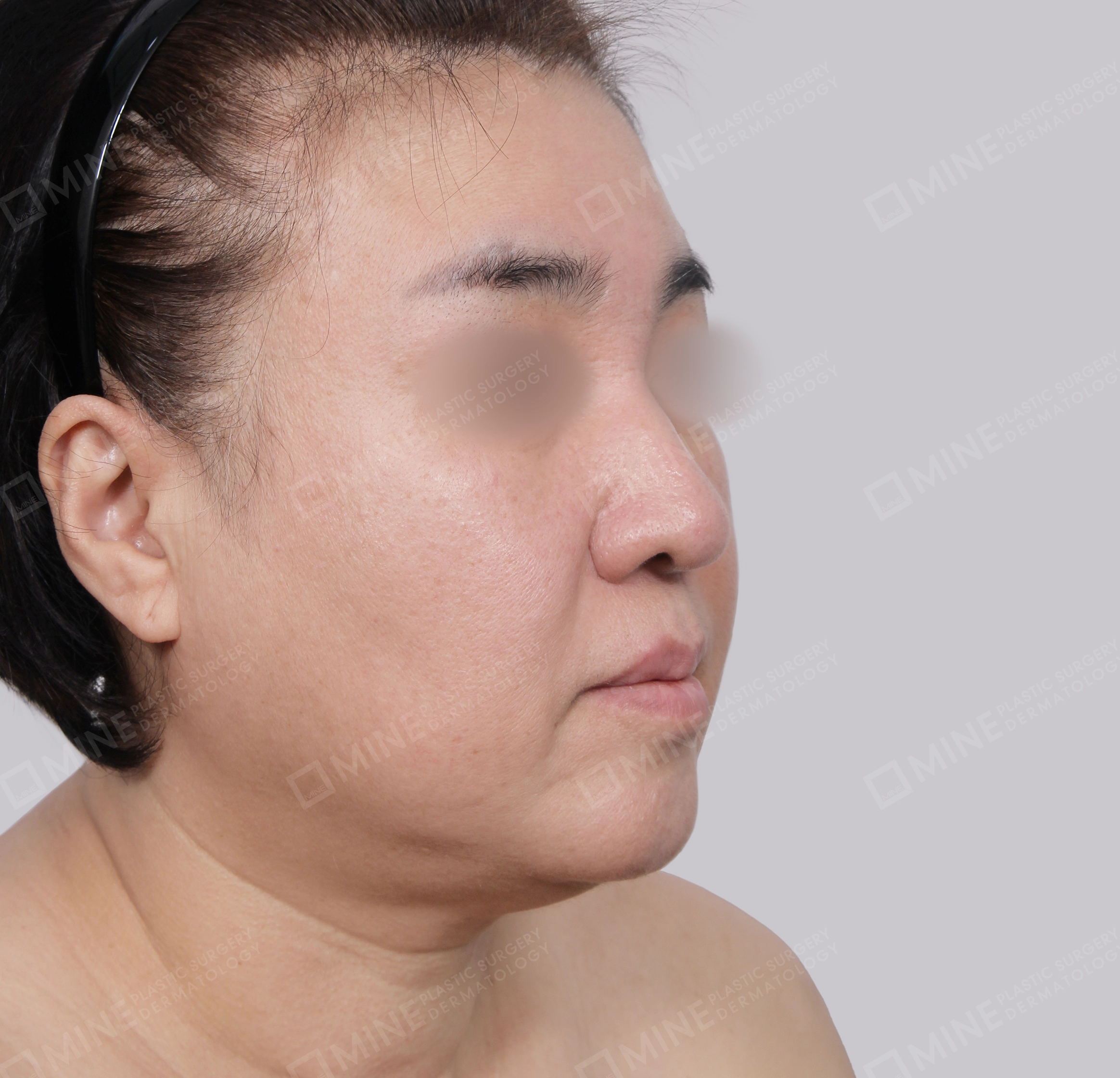 Căng da toàn mặt-45 độ-Trước
