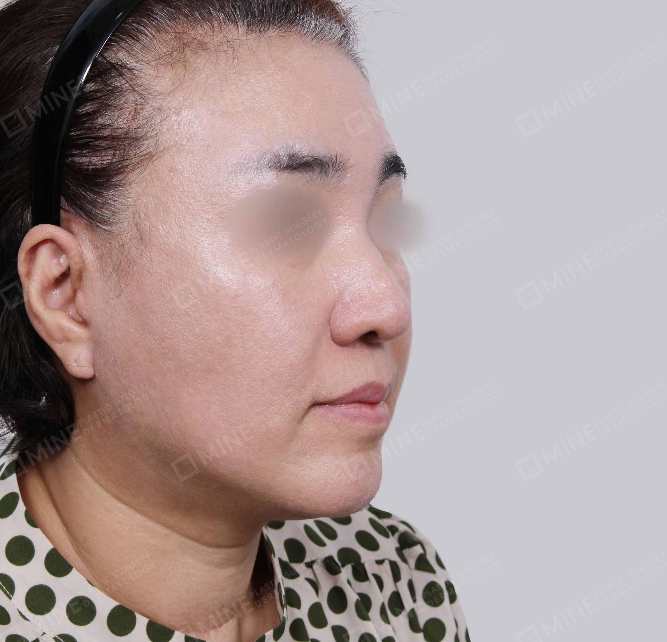 Căng da toàn mặt-45 độ-Sau