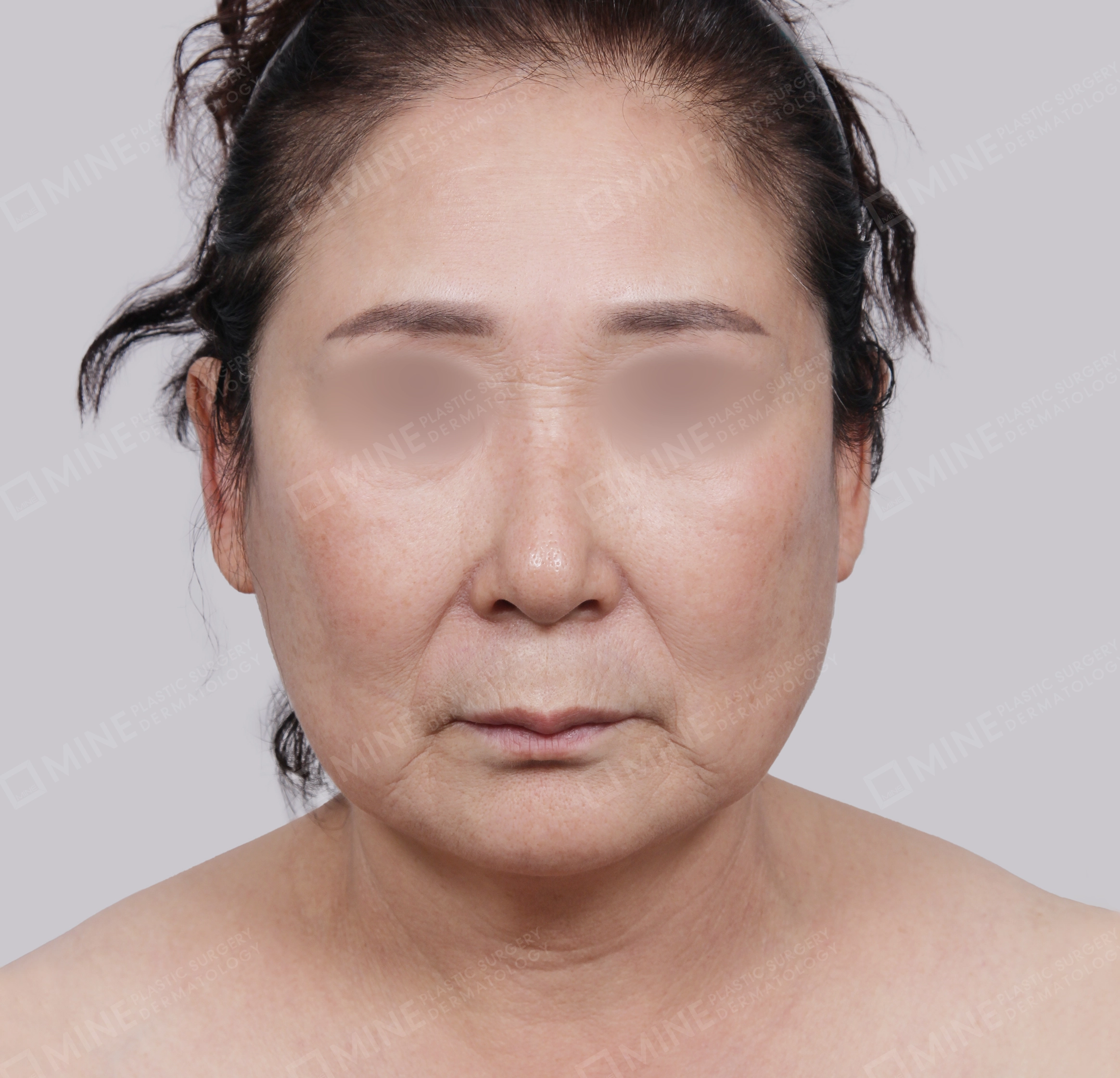 Căng da toàn mặt-Mặt trước-Trước