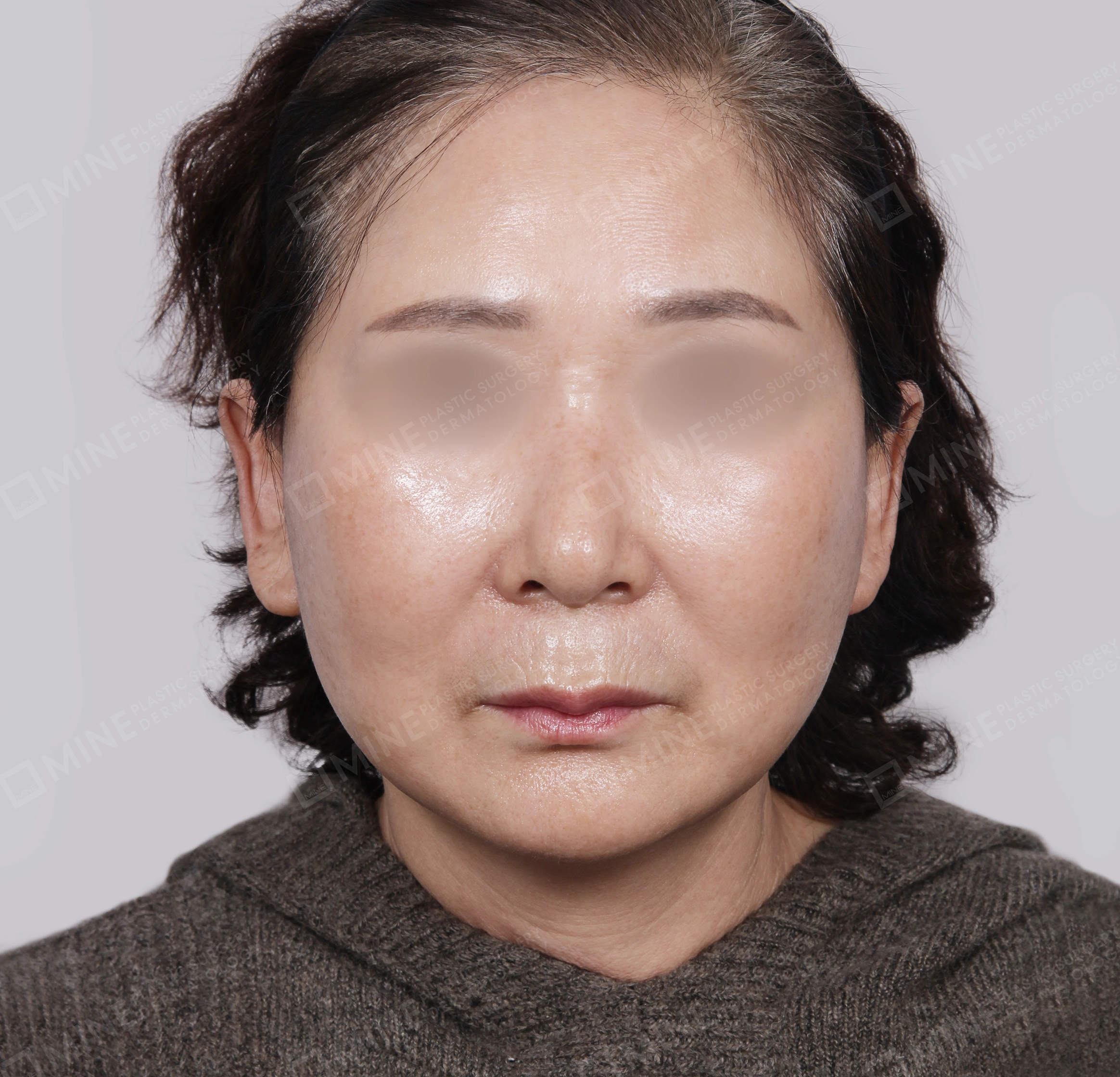 Căng da toàn mặt-Mặt trước-Sau