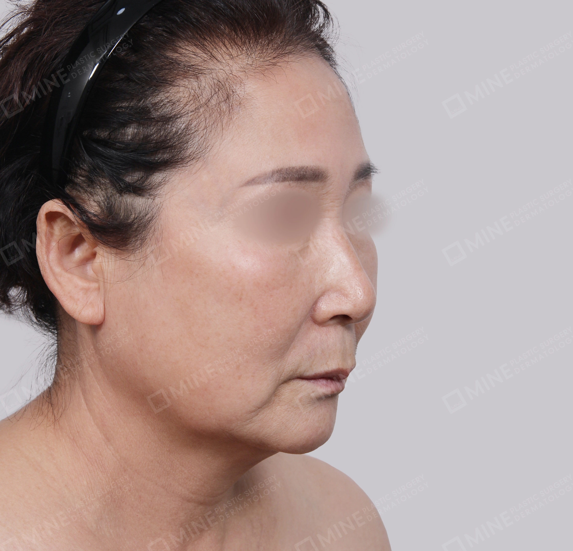 Căng da toàn mặt-45 độ-Trước