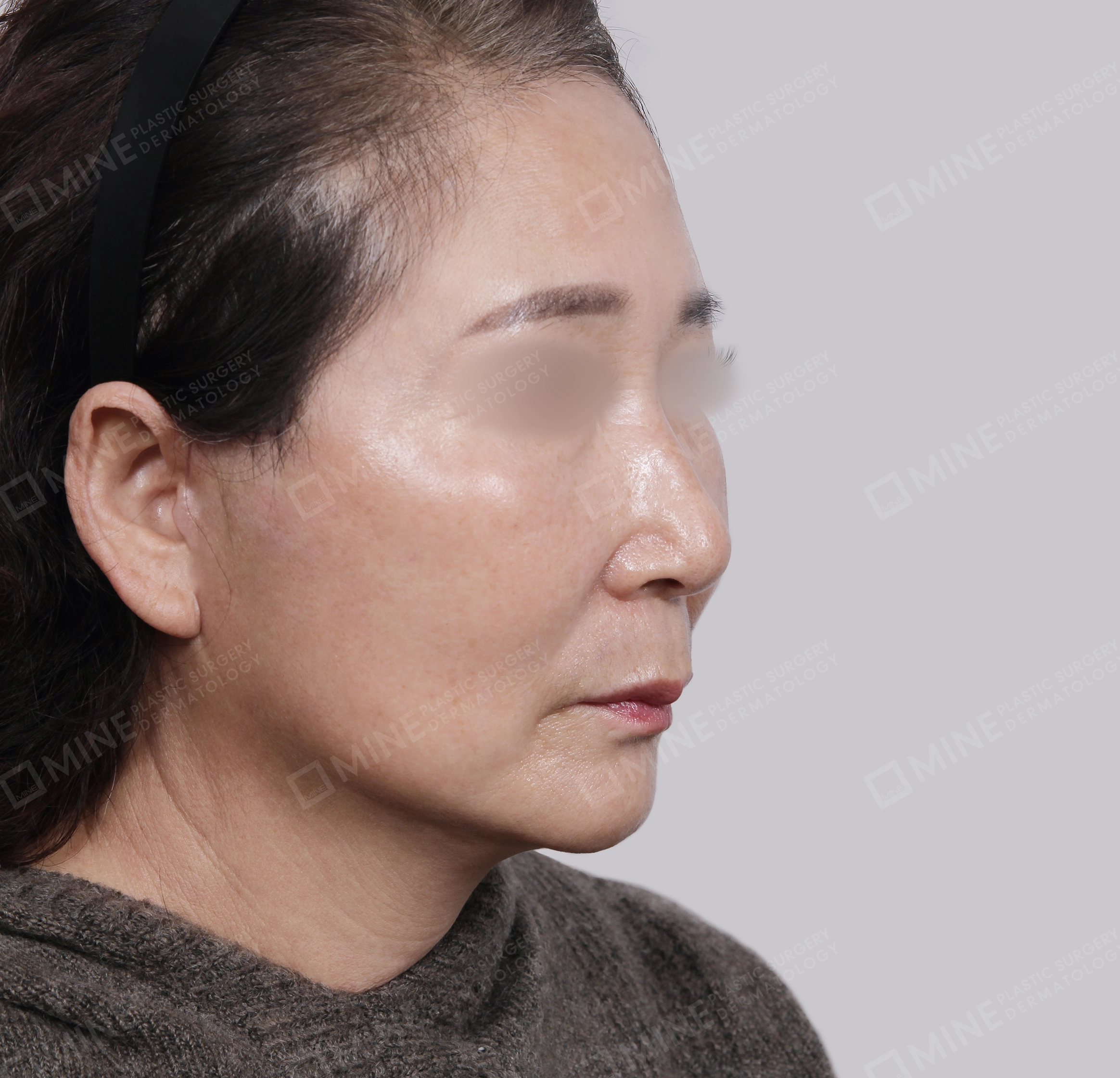 Căng da toàn mặt-45 độ-Sau