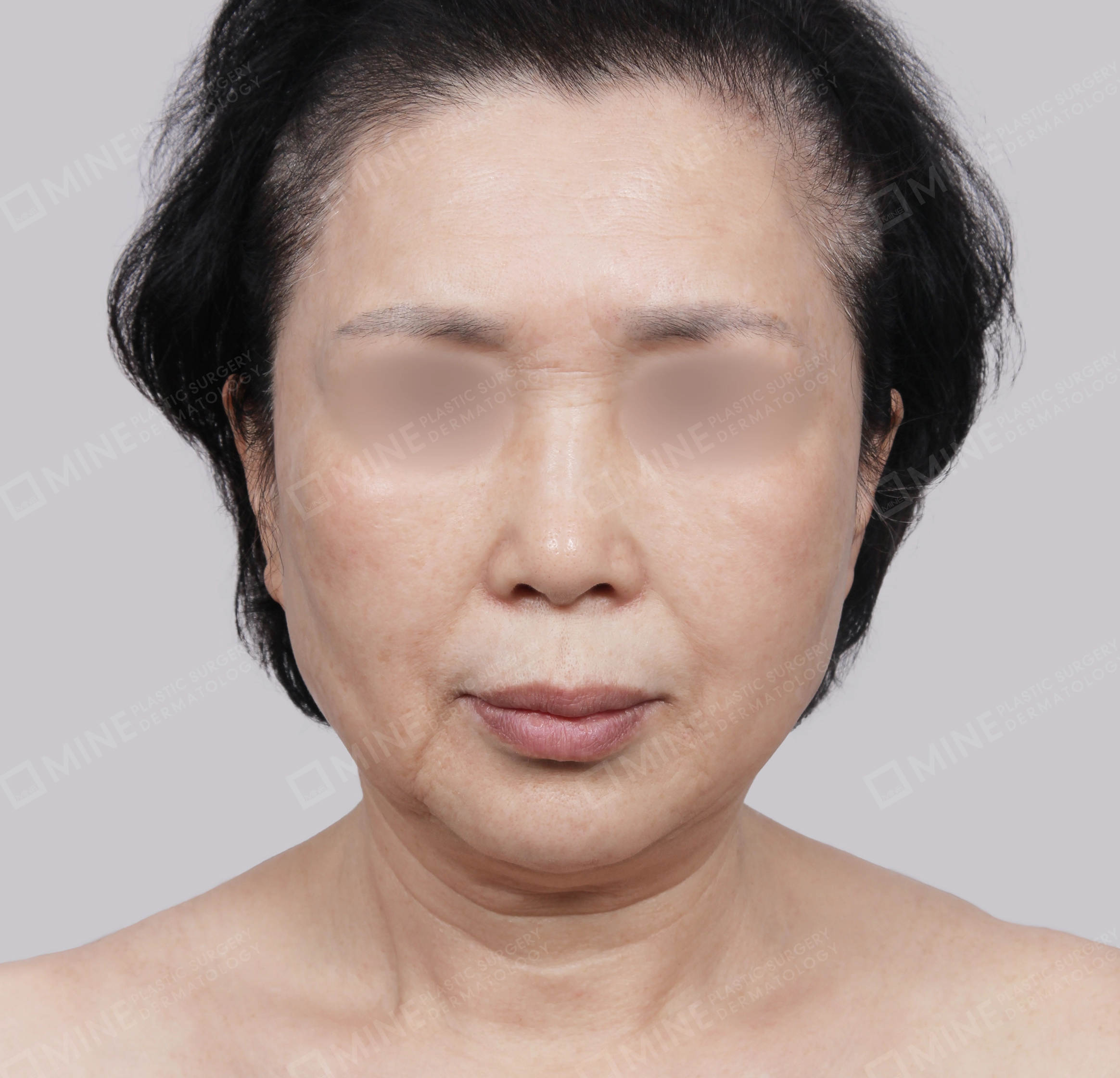 Căng da toàn mặt-Mặt trước-Trước