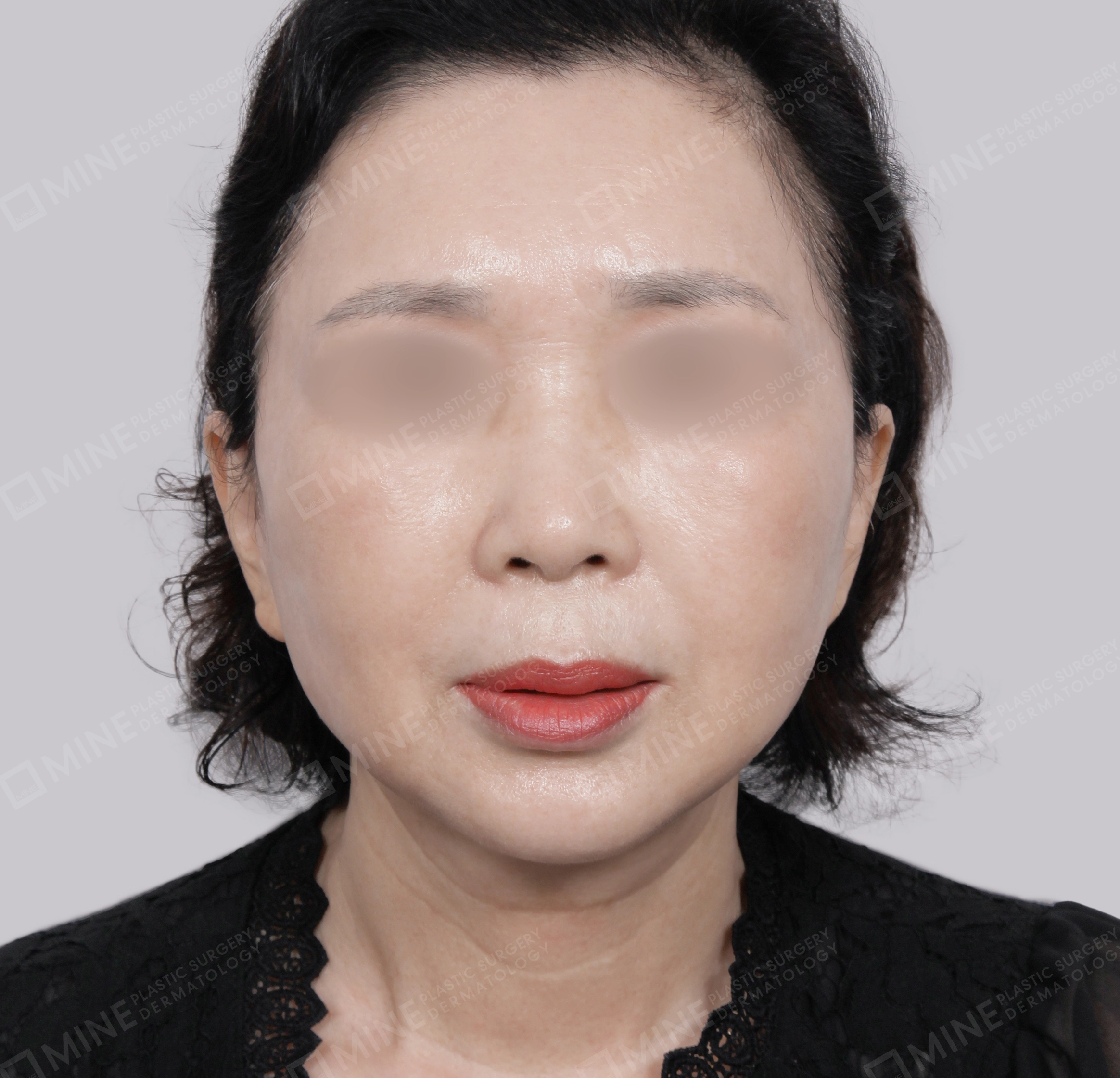 Căng da toàn mặt-Mặt trước-Sau