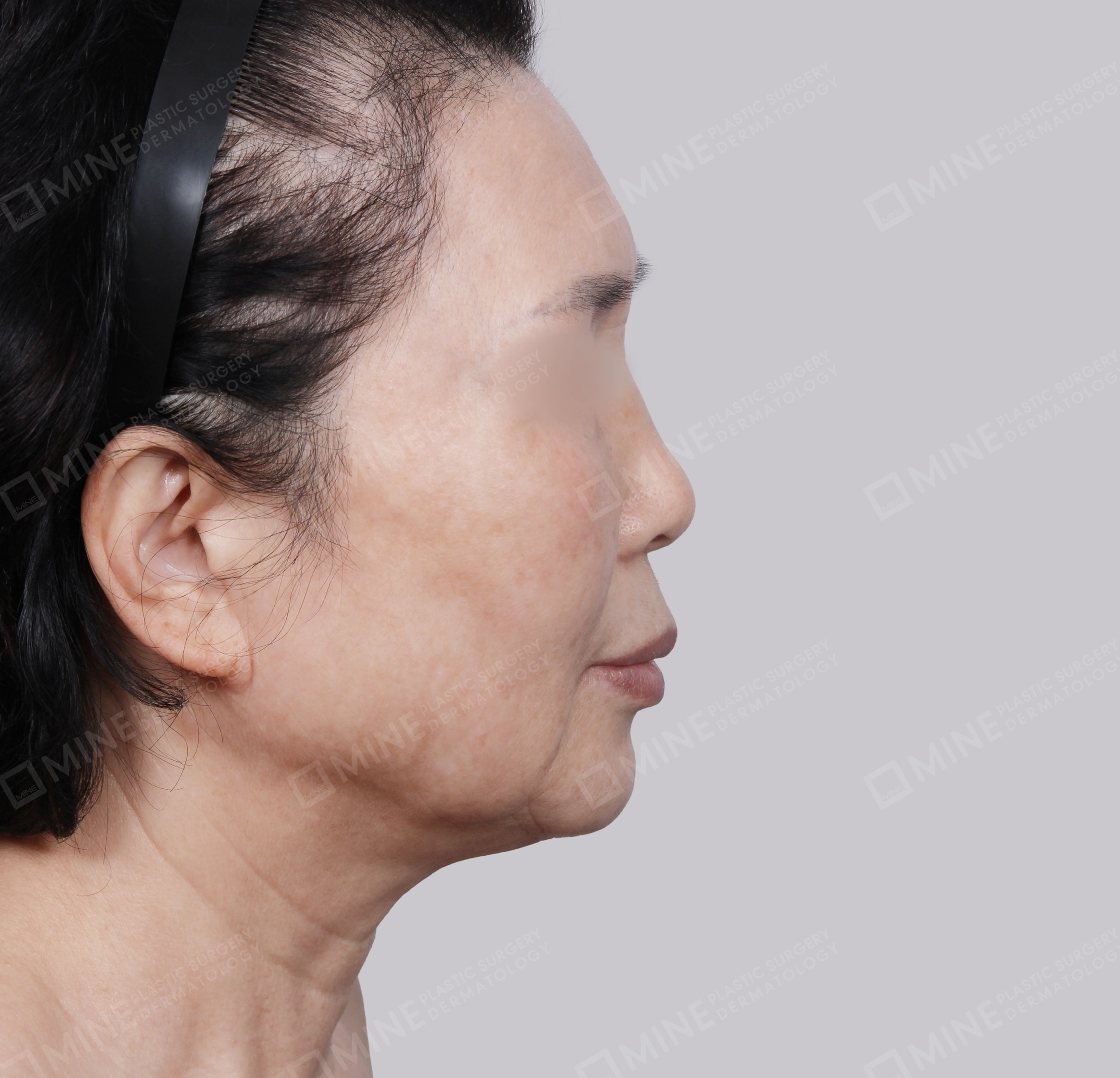 Căng da toàn mặt-Mặt bên-Trước