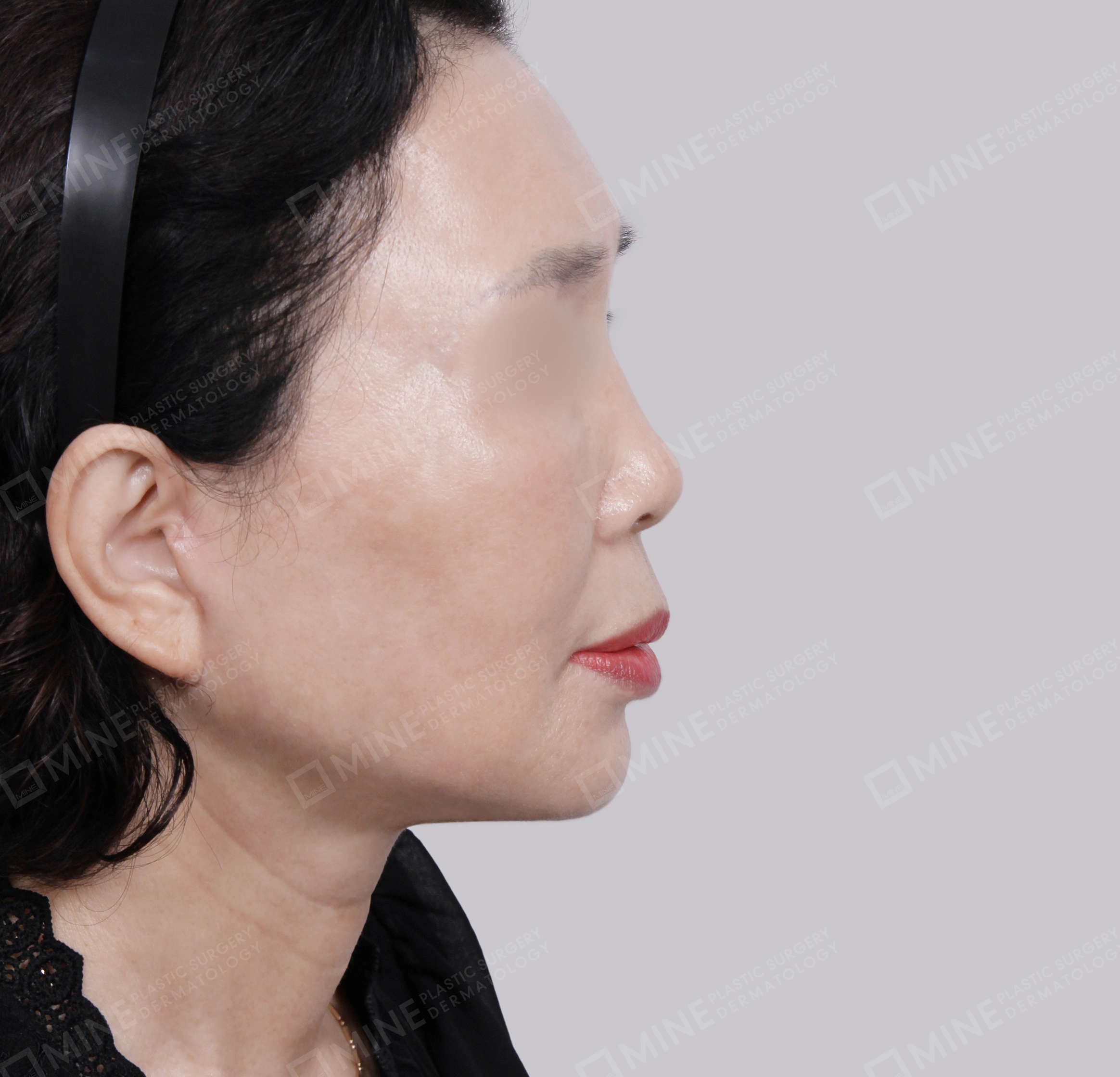 Căng da toàn mặt-Mặt bên-Sau