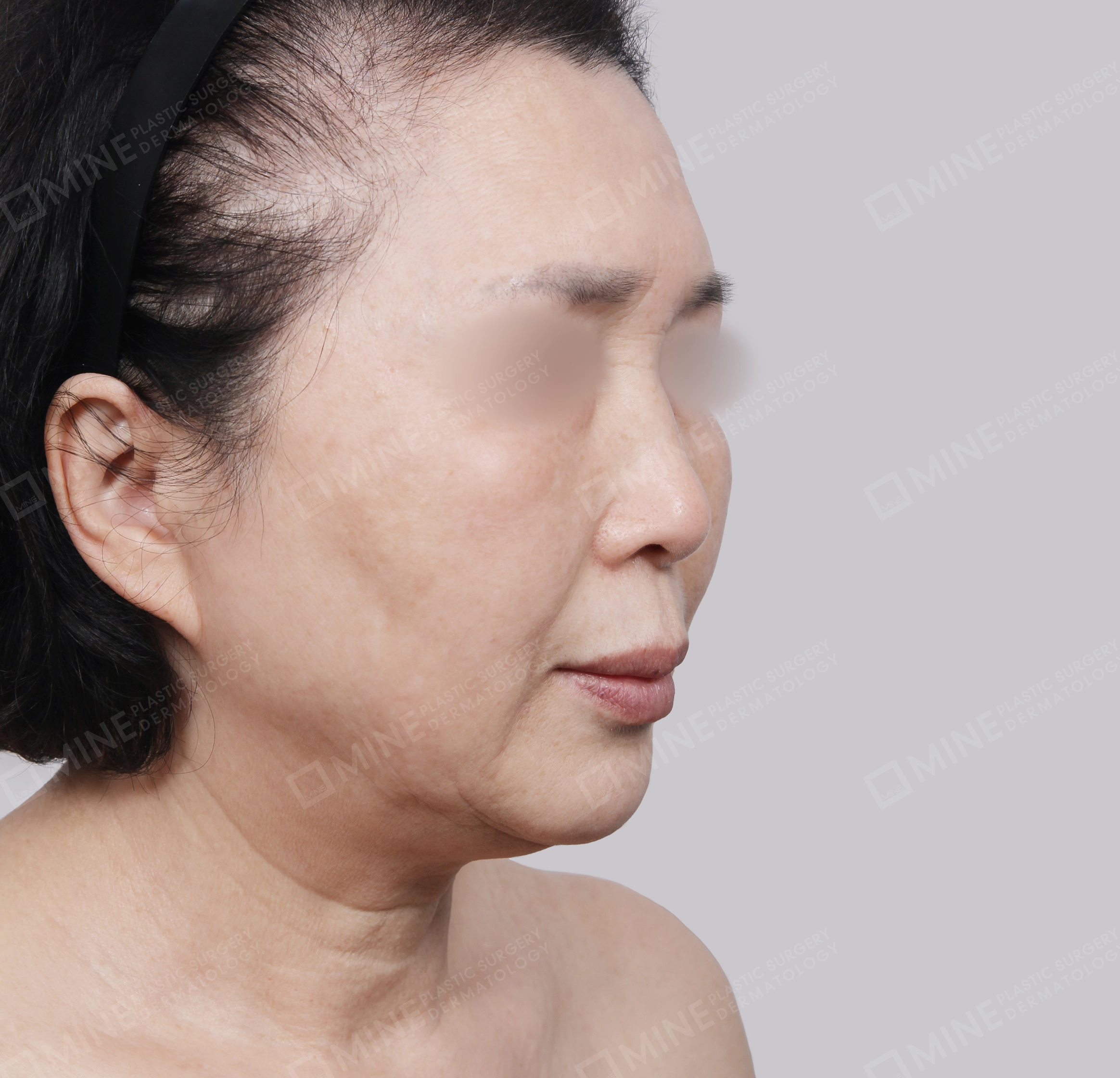 Căng da toàn mặt-45 độ-Trước