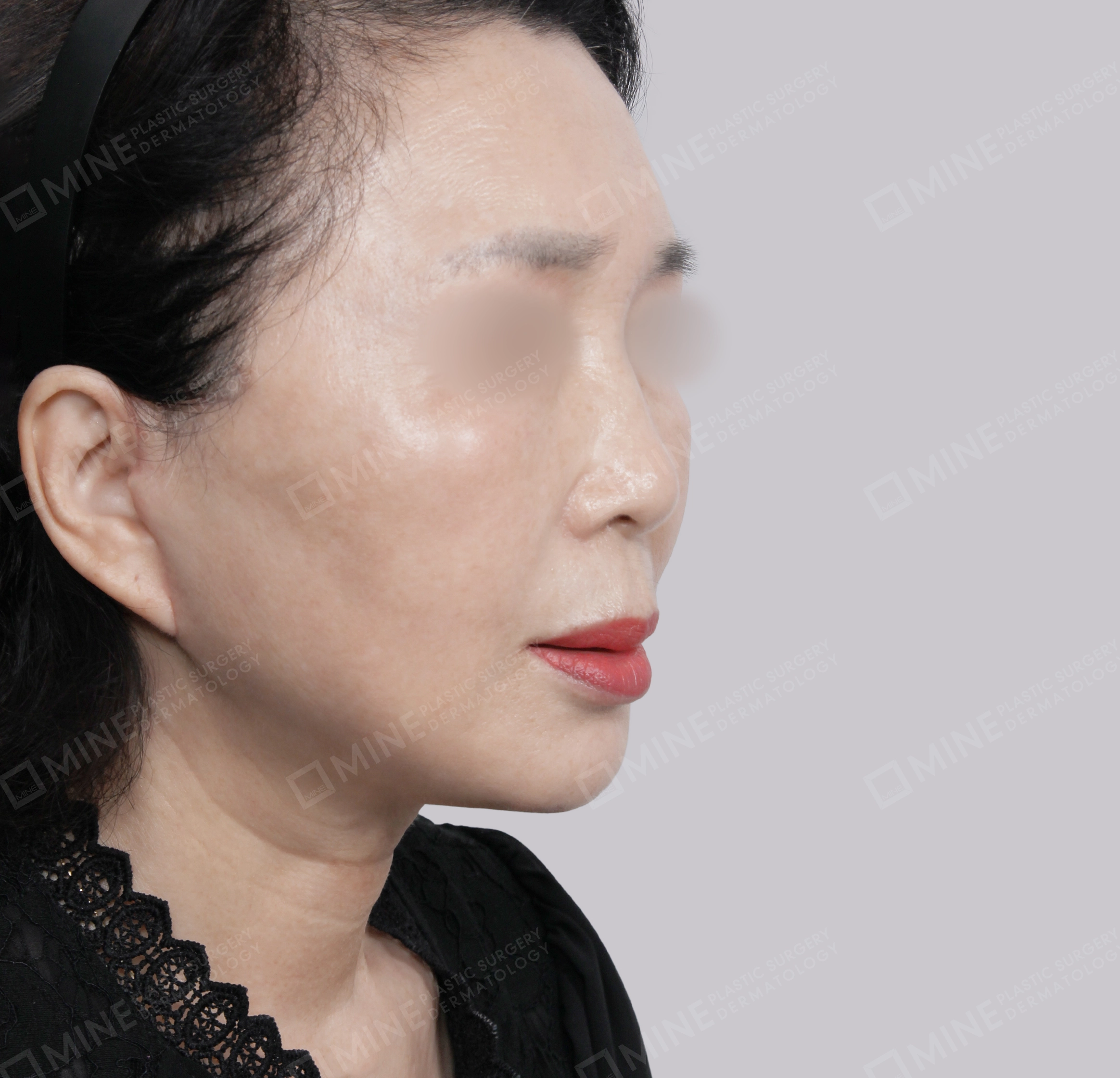 Căng da toàn mặt-45 độ-Sau