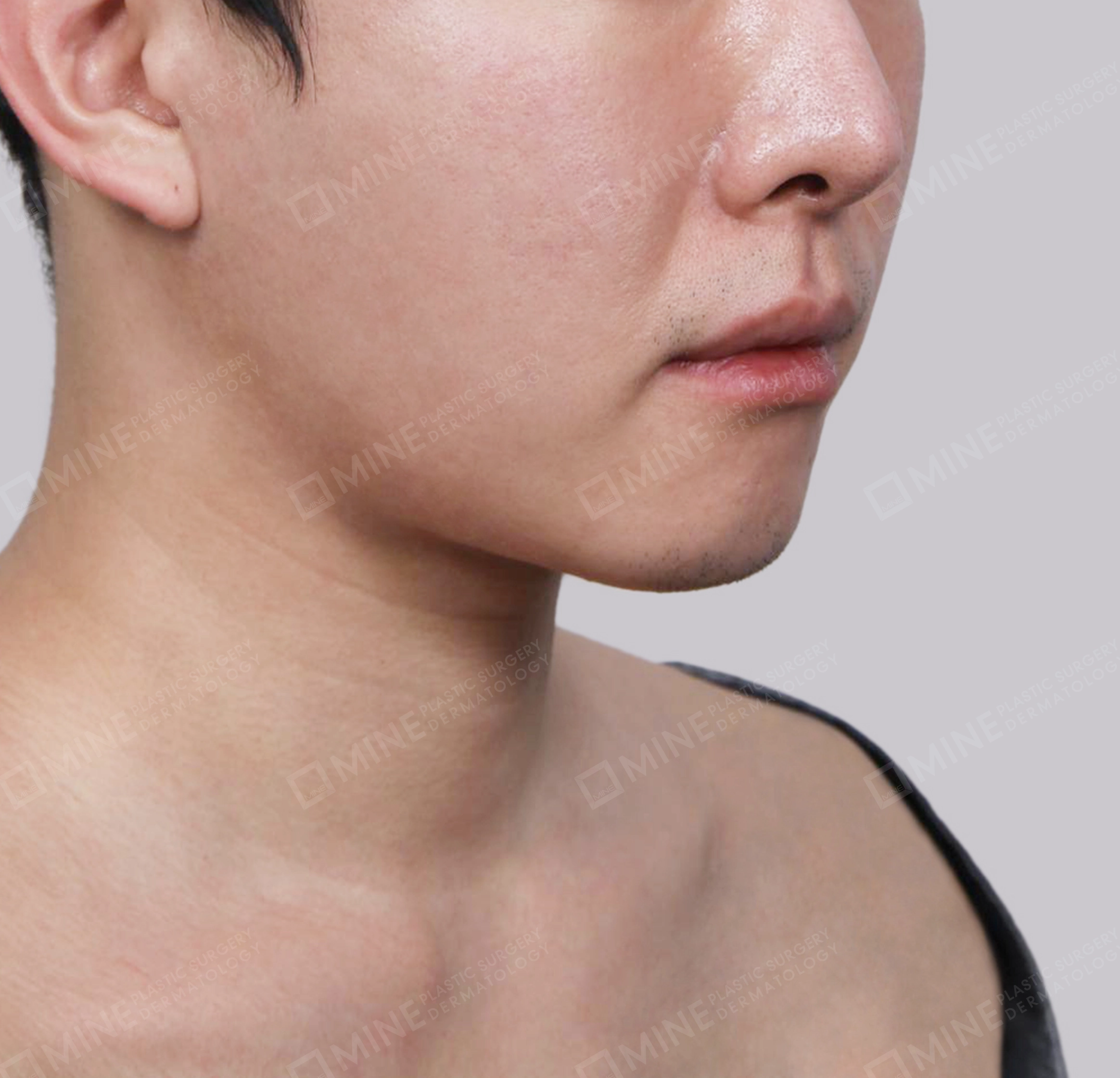 Hút mỡ nọng buộc cơ-Mặt trước-Trước