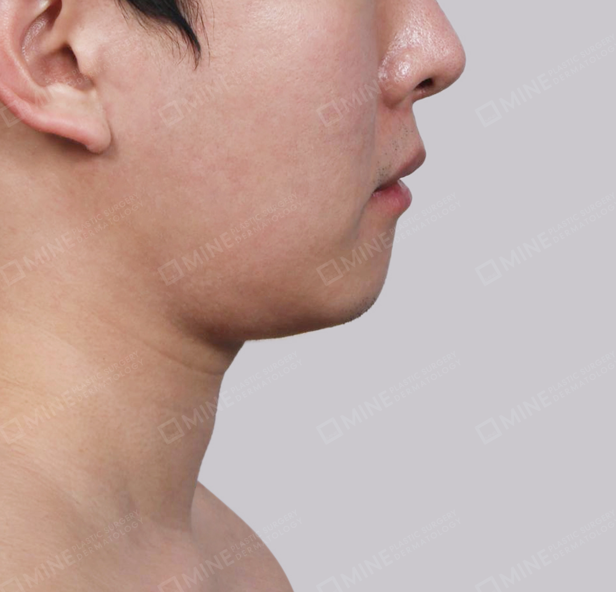 Hút mỡ nọng buộc cơ-Mặt bên-Trước
