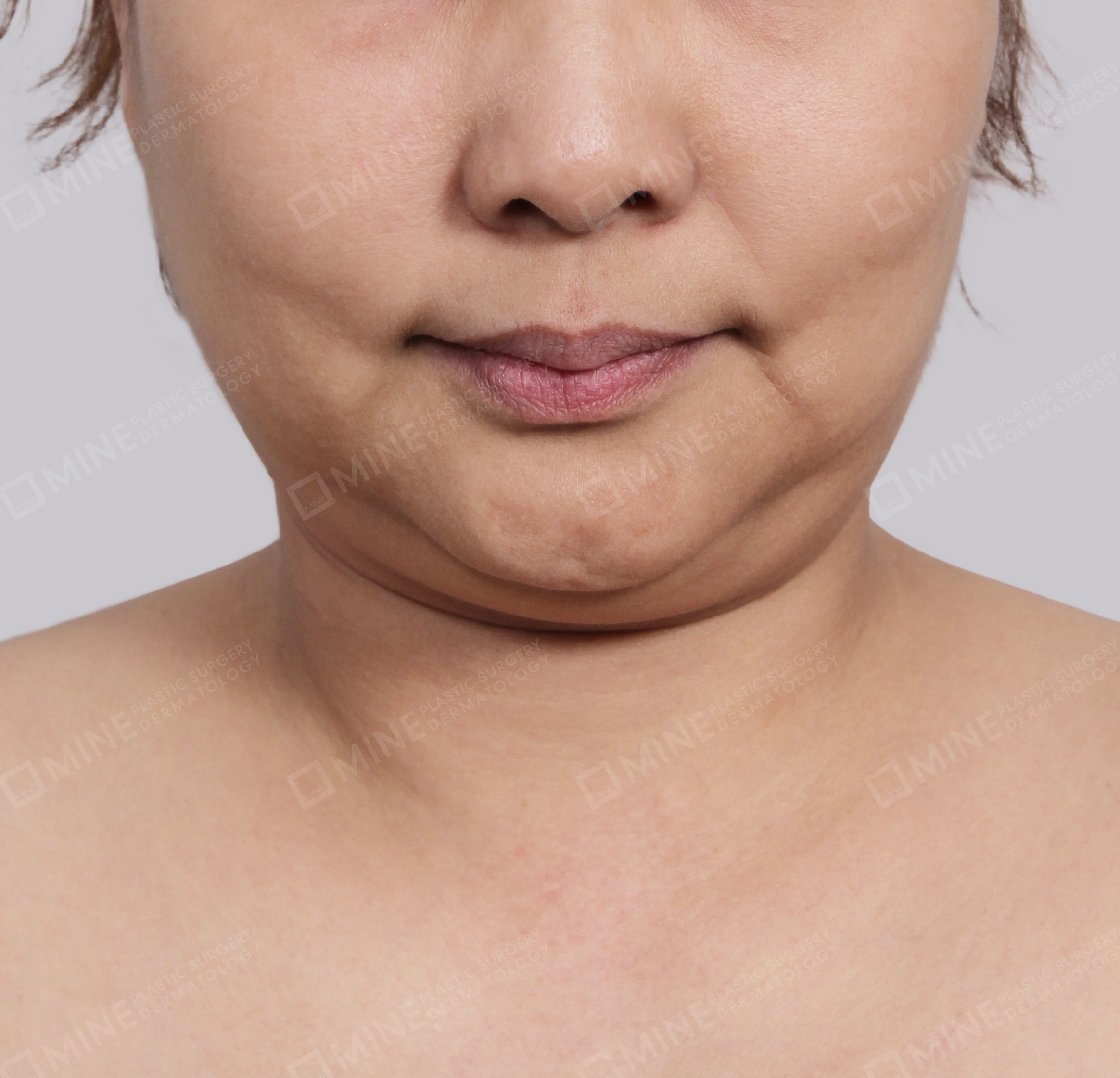 Hút mỡ nọng buộc cơ-Mặt trước-Trước