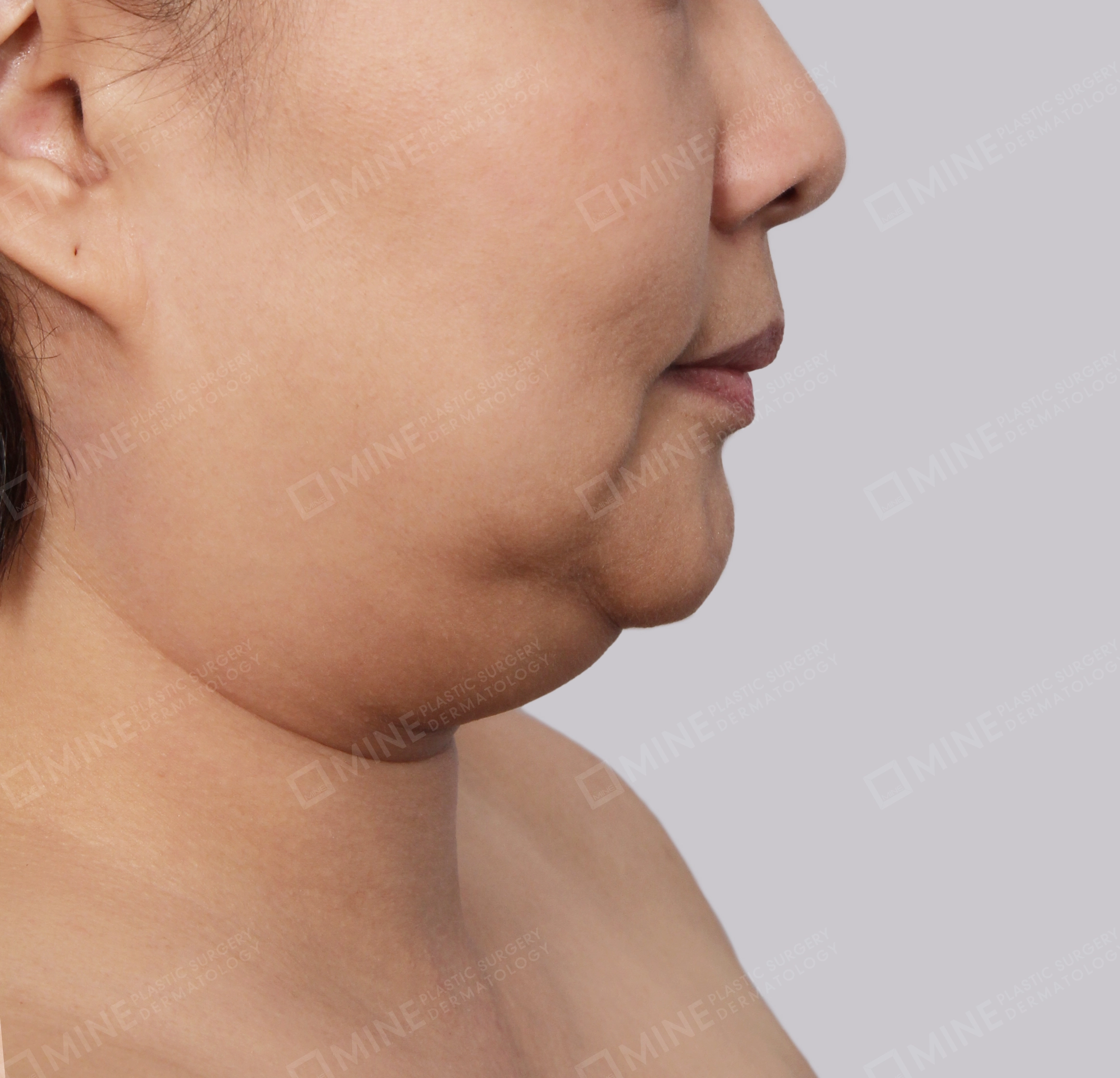 Hút mỡ nọng buộc cơ-Mặt bên-Trước