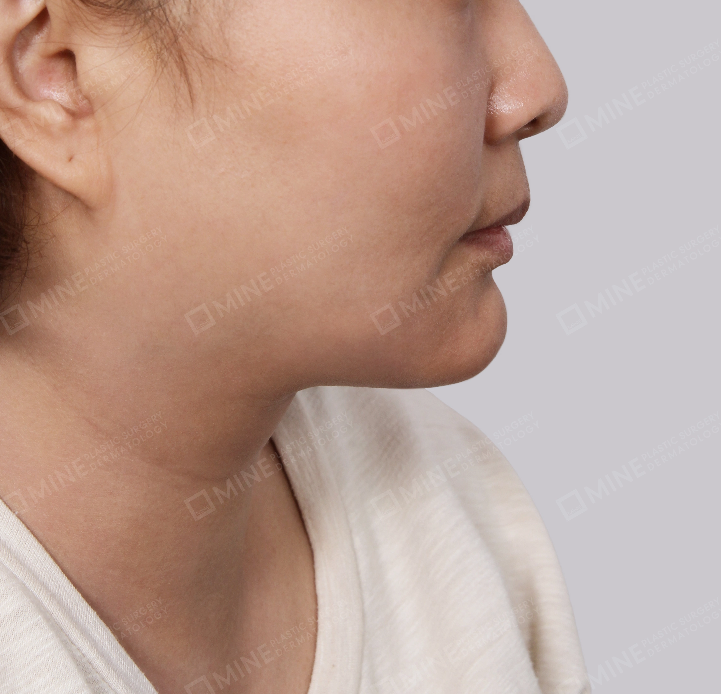 Hút mỡ nọng buộc cơ-Mặt bên-Sau