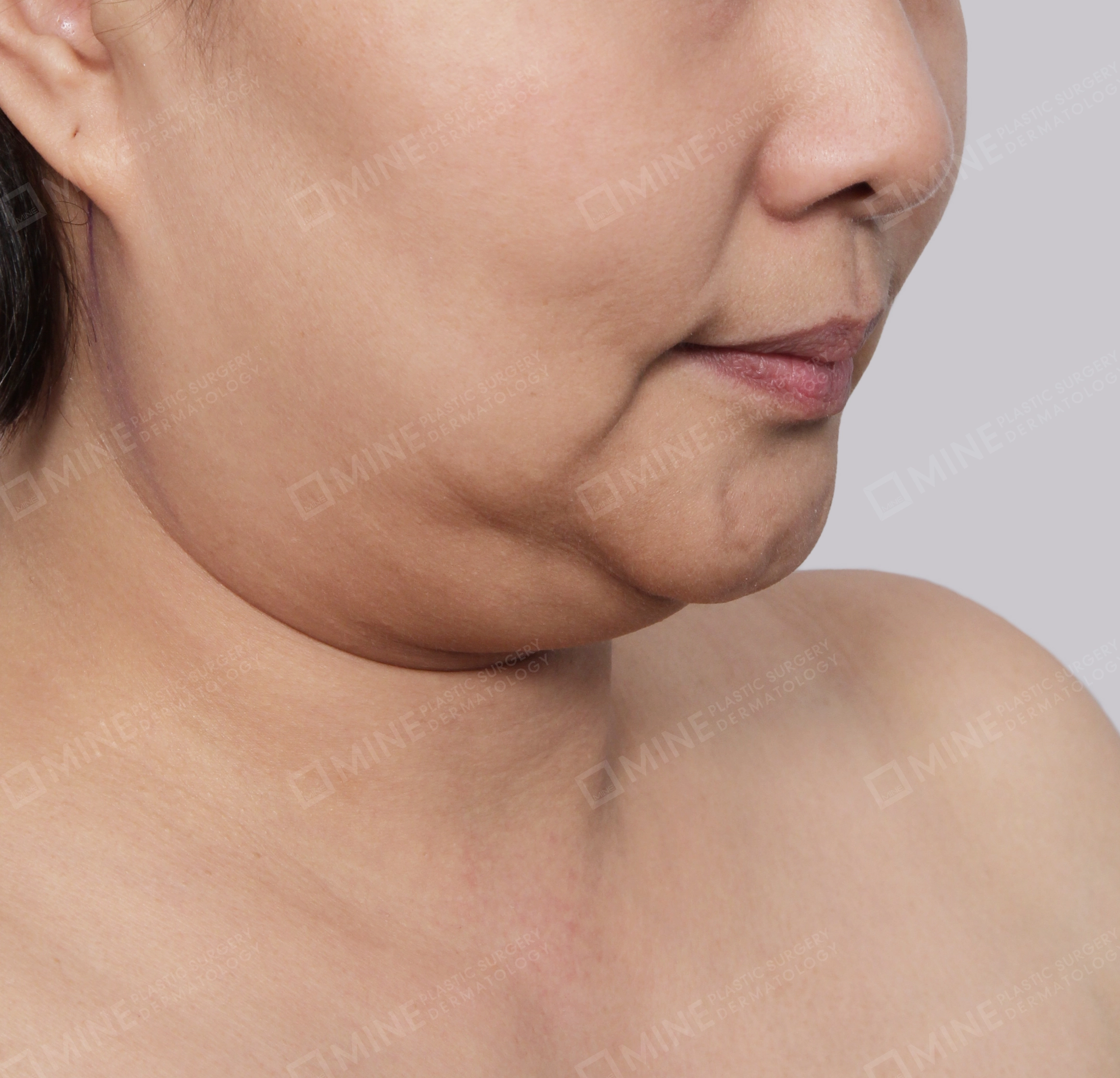 Hút mỡ nọng buộc cơ-45 độ-Trước