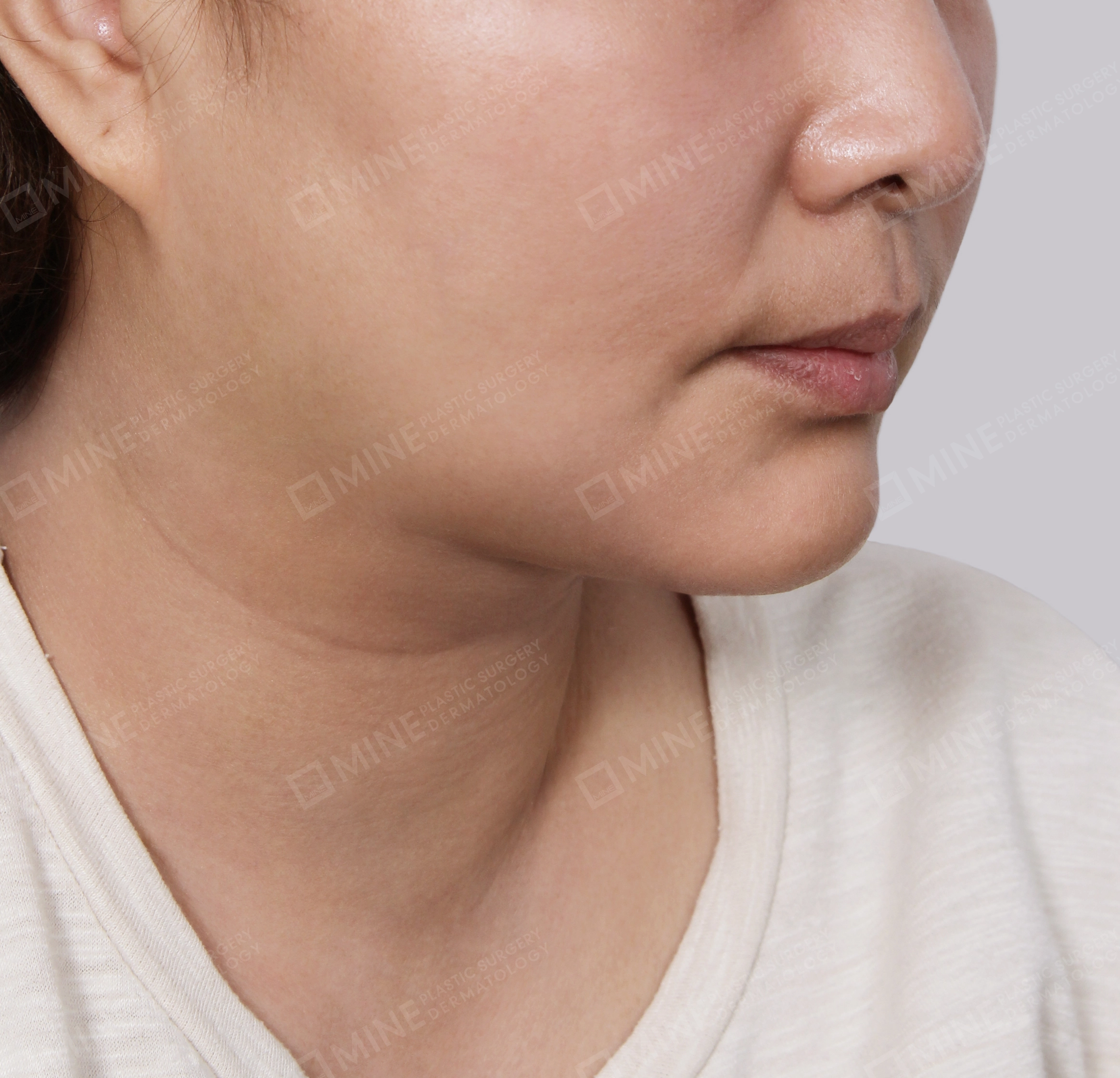 Hút mỡ nọng buộc cơ-45 độ-Sau