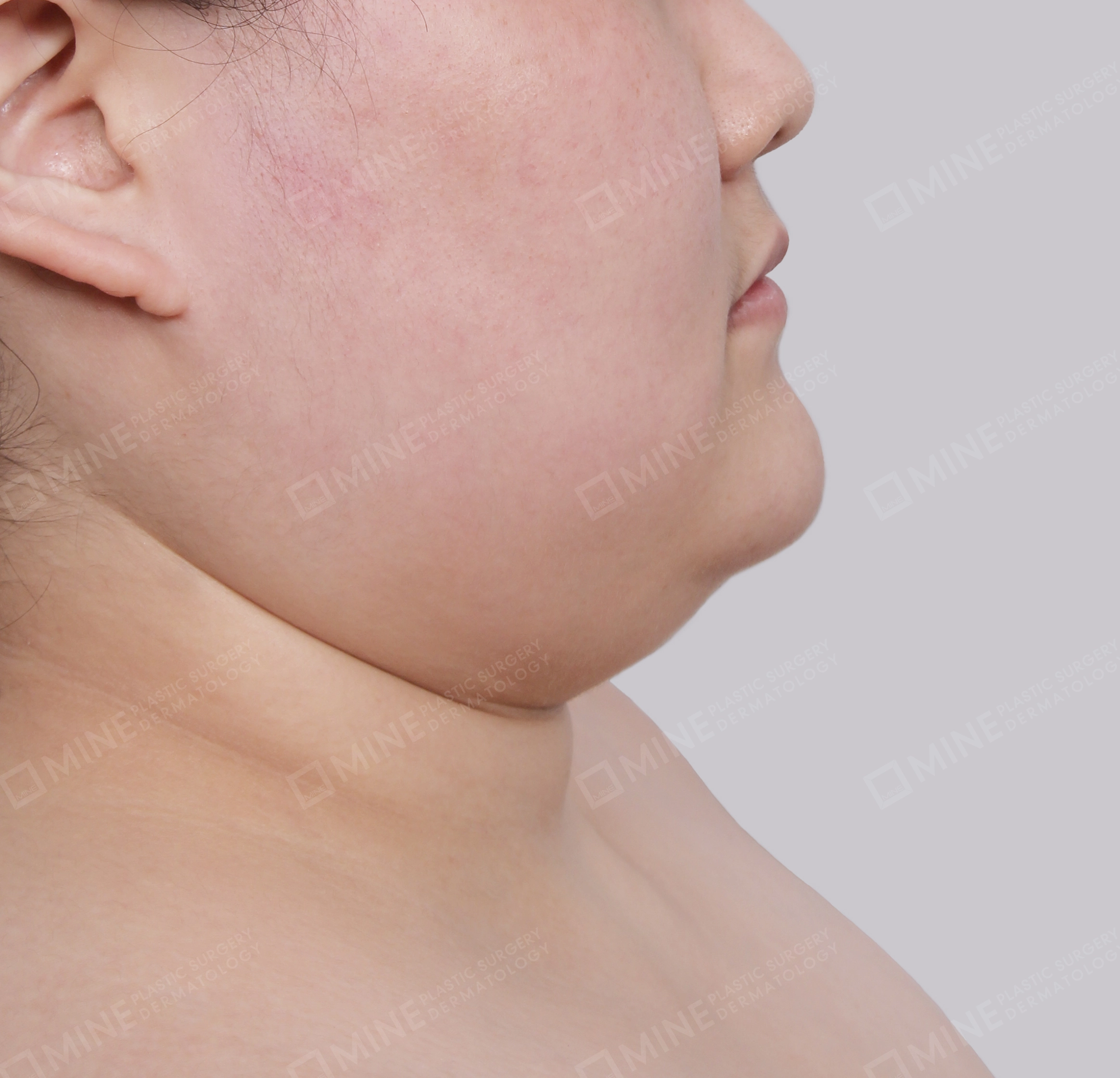 Hút mỡ nọng buộc cơ-Mặt bên-Trước
