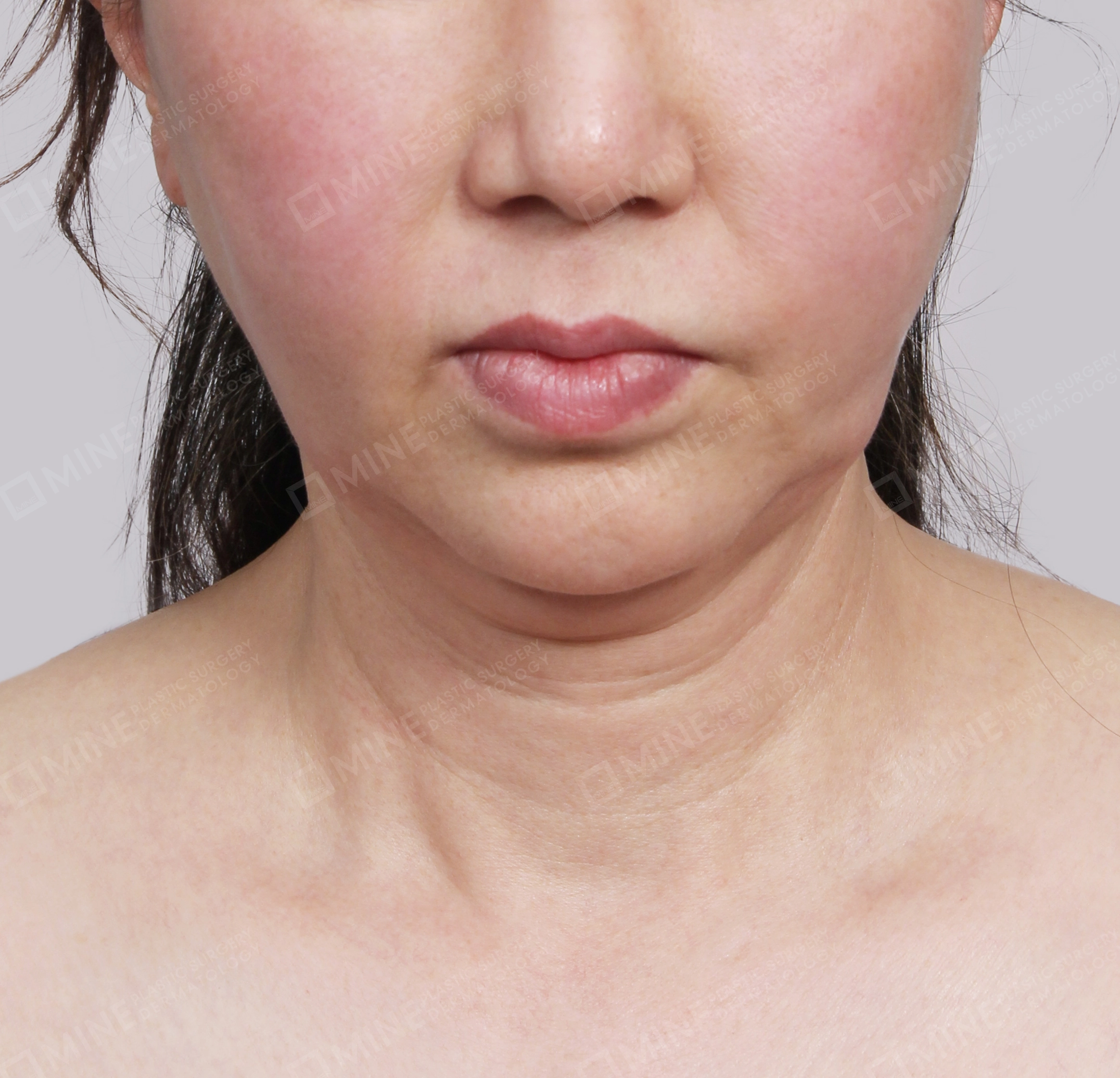 Hút mỡ nọng buộc cơ-Mặt trước-Trước