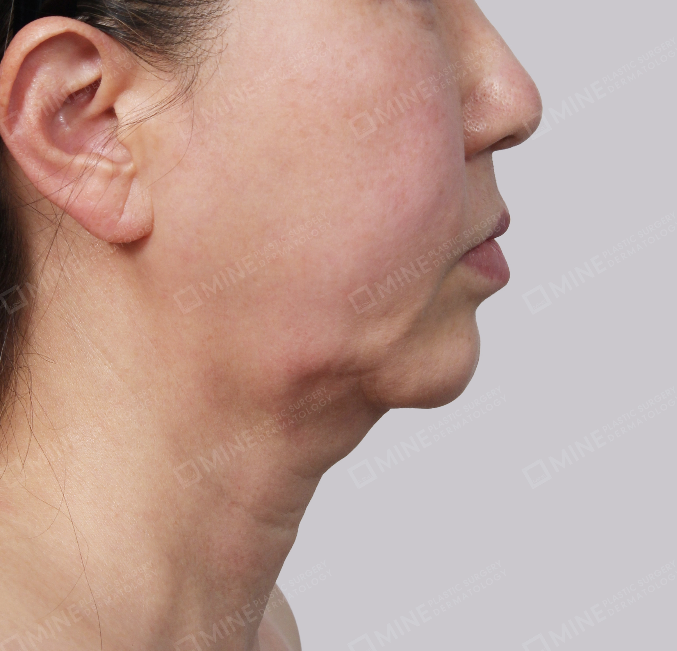 Hút mỡ nọng buộc cơ-Mặt bên-Trước