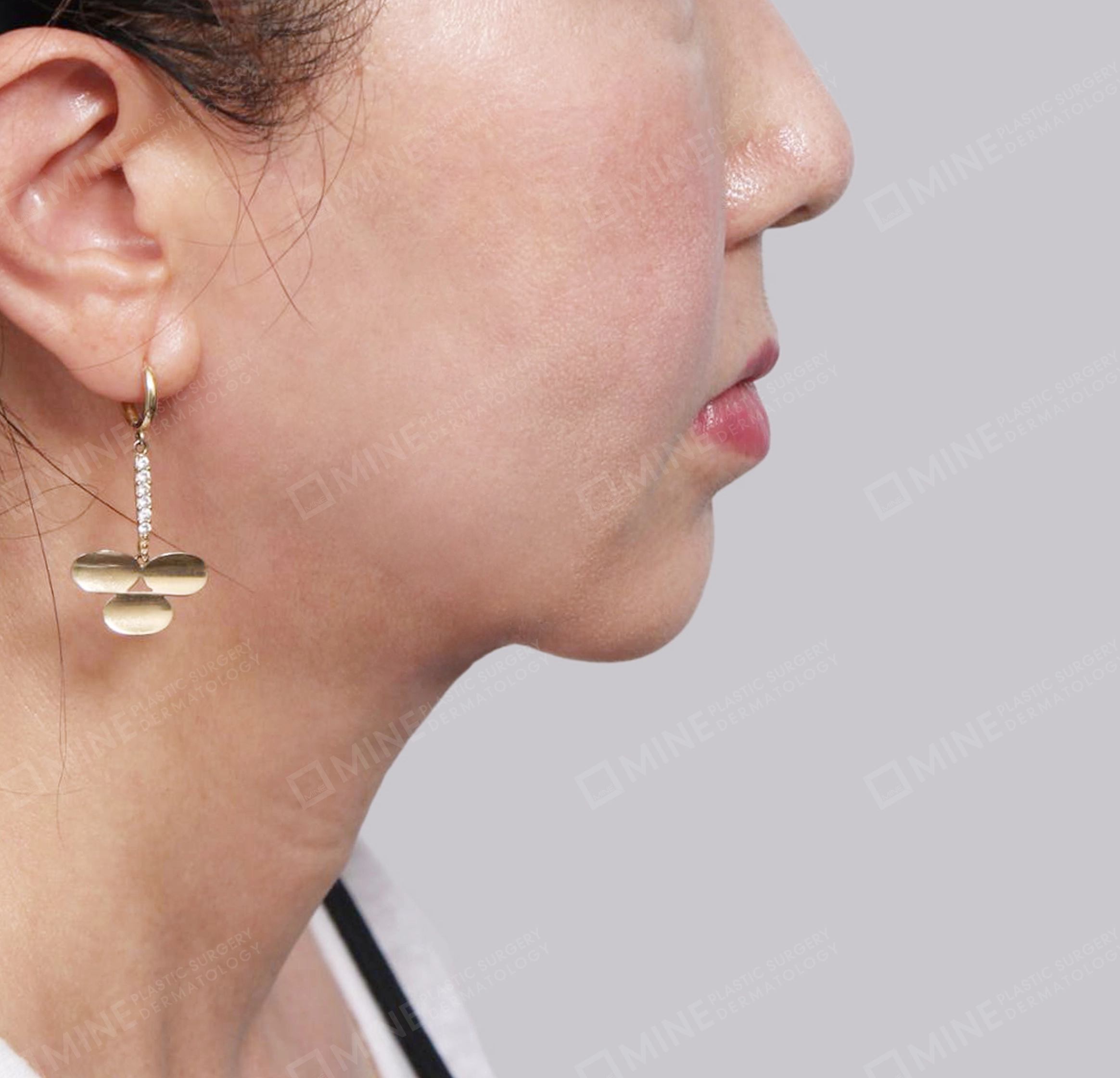 Hút mỡ nọng buộc cơ-Mặt bên-Sau