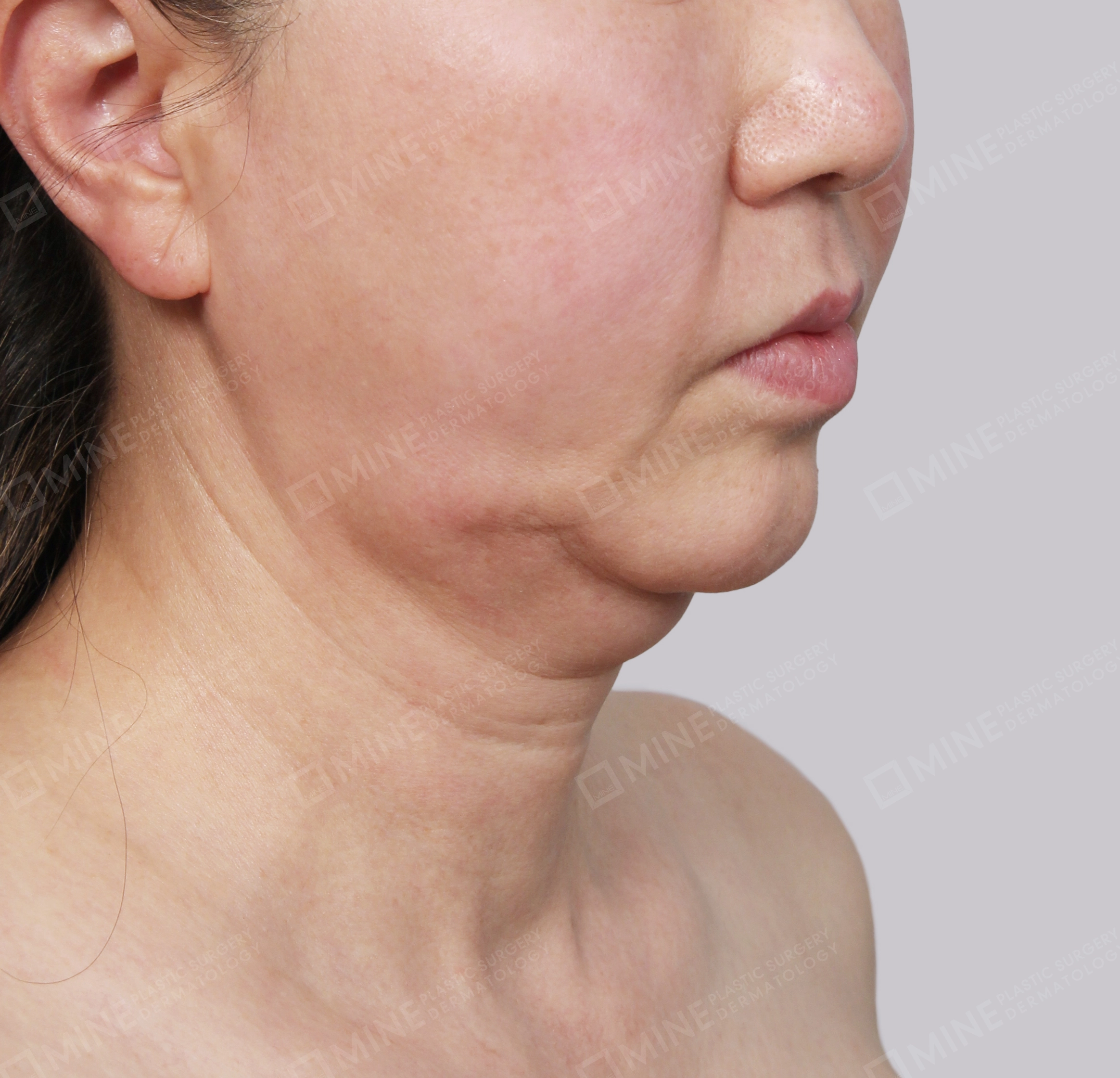 Hút mỡ nọng buộc cơ-45 độ-Trước