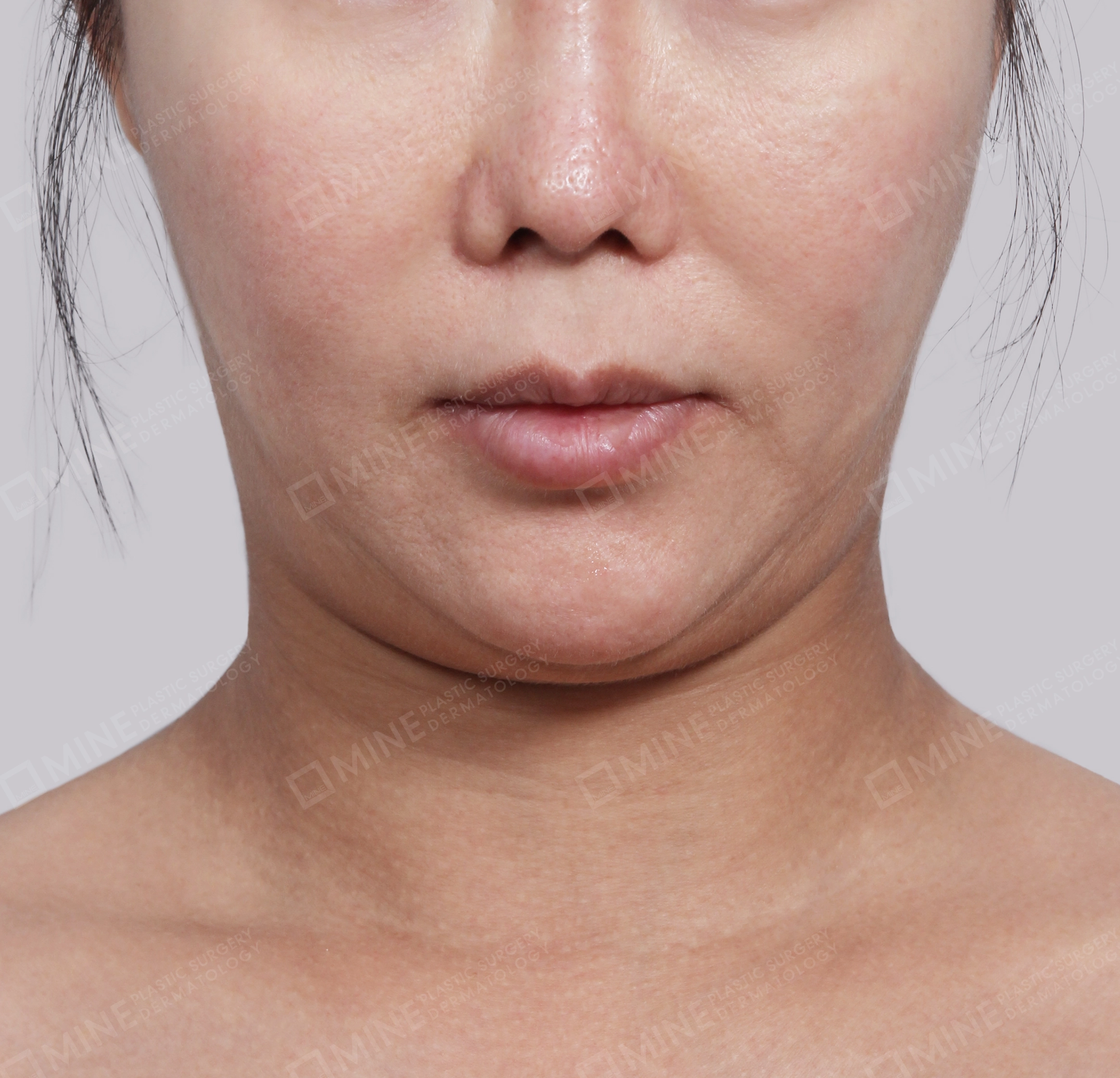 Hút mỡ nọng buộc cơ-Mặt trước-Trước
