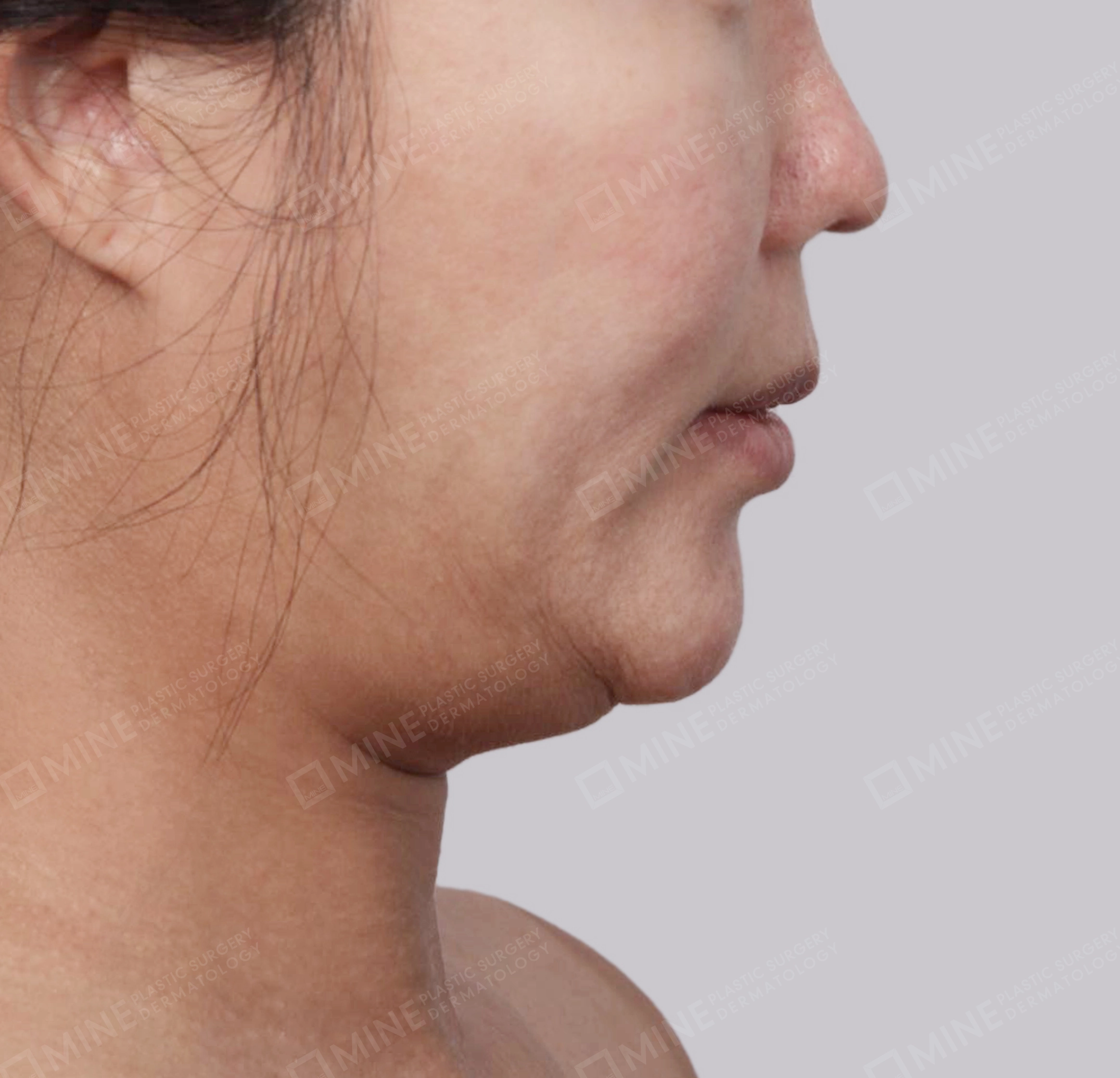 Hút mỡ nọng buộc cơ-Mặt bên-Trước