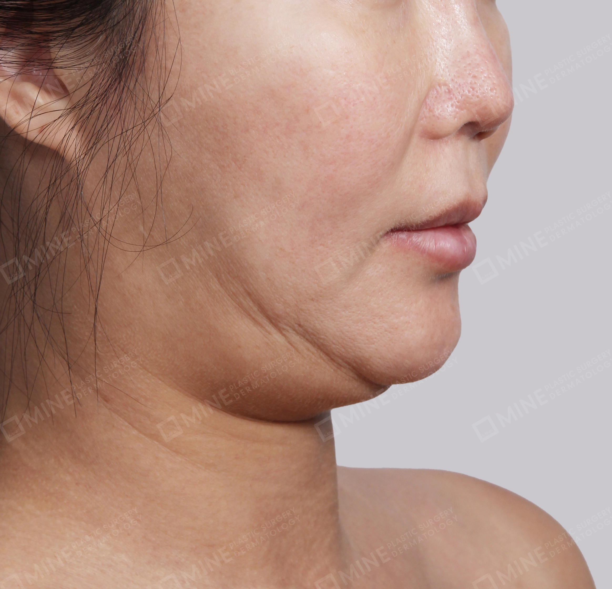 Hút mỡ nọng buộc cơ-45 độ-Trước