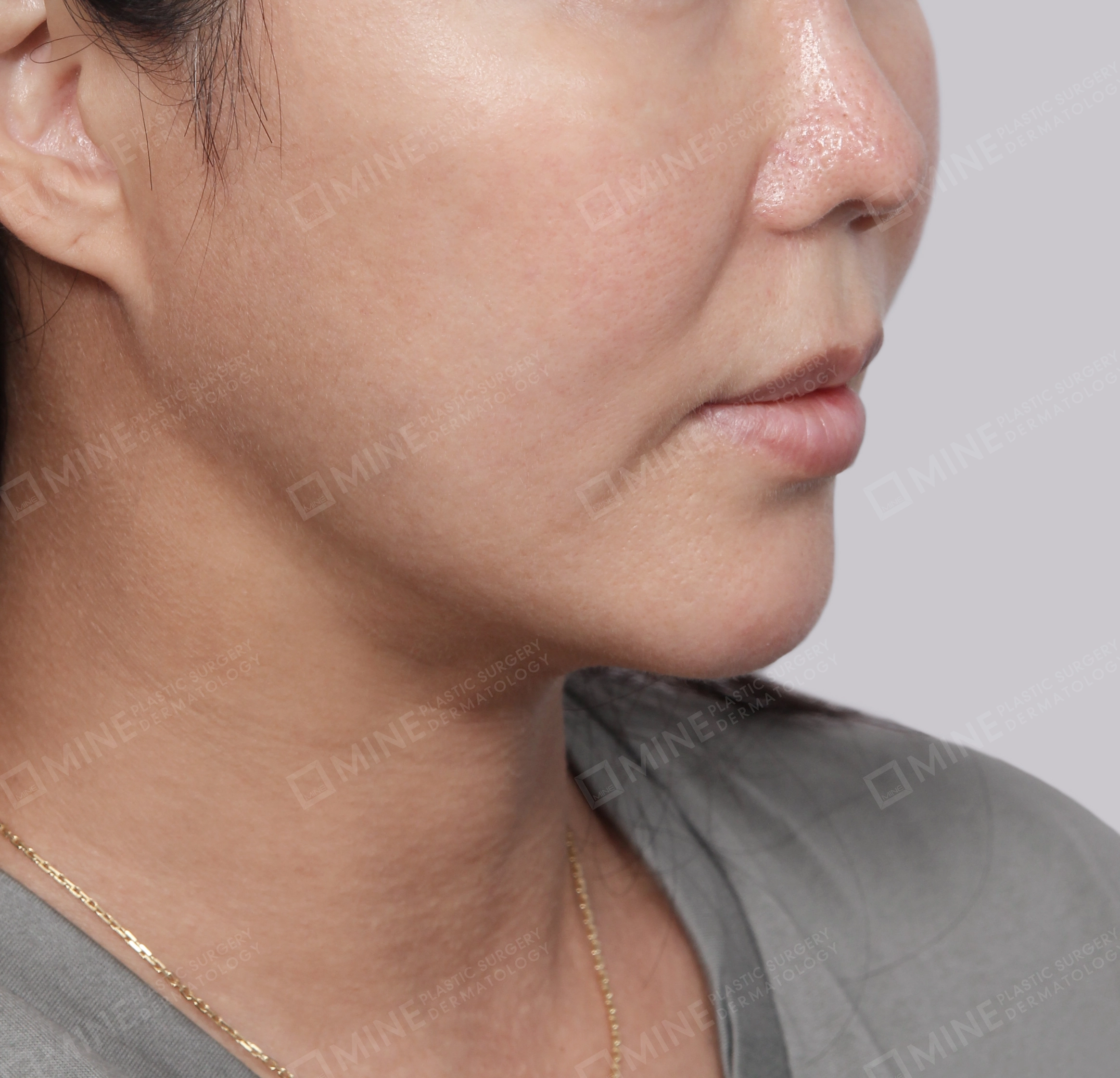 Hút mỡ nọng buộc cơ-45 độ-Sau