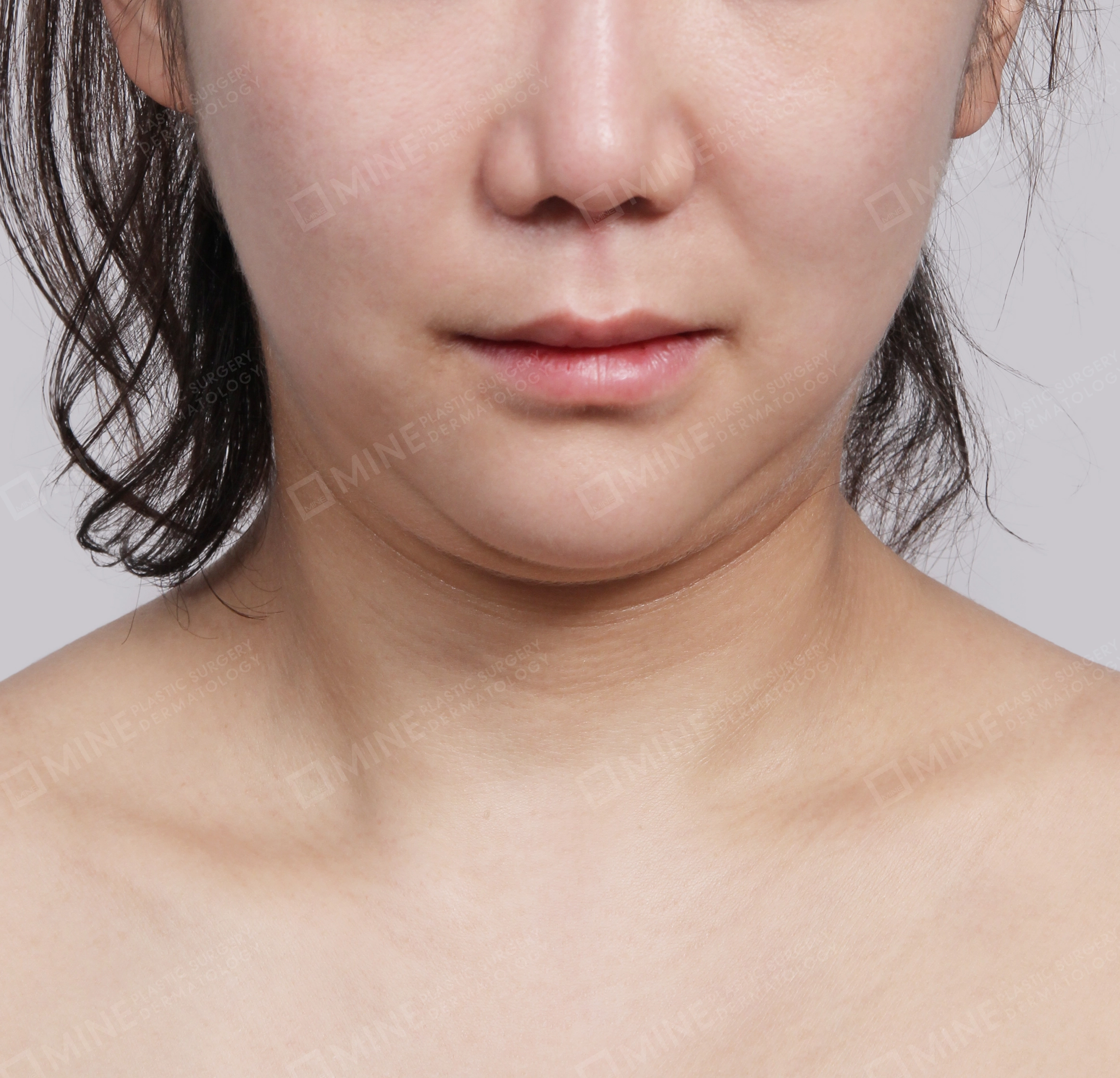 Hút mỡ nọng buộc cơ-Mặt trước-Trước